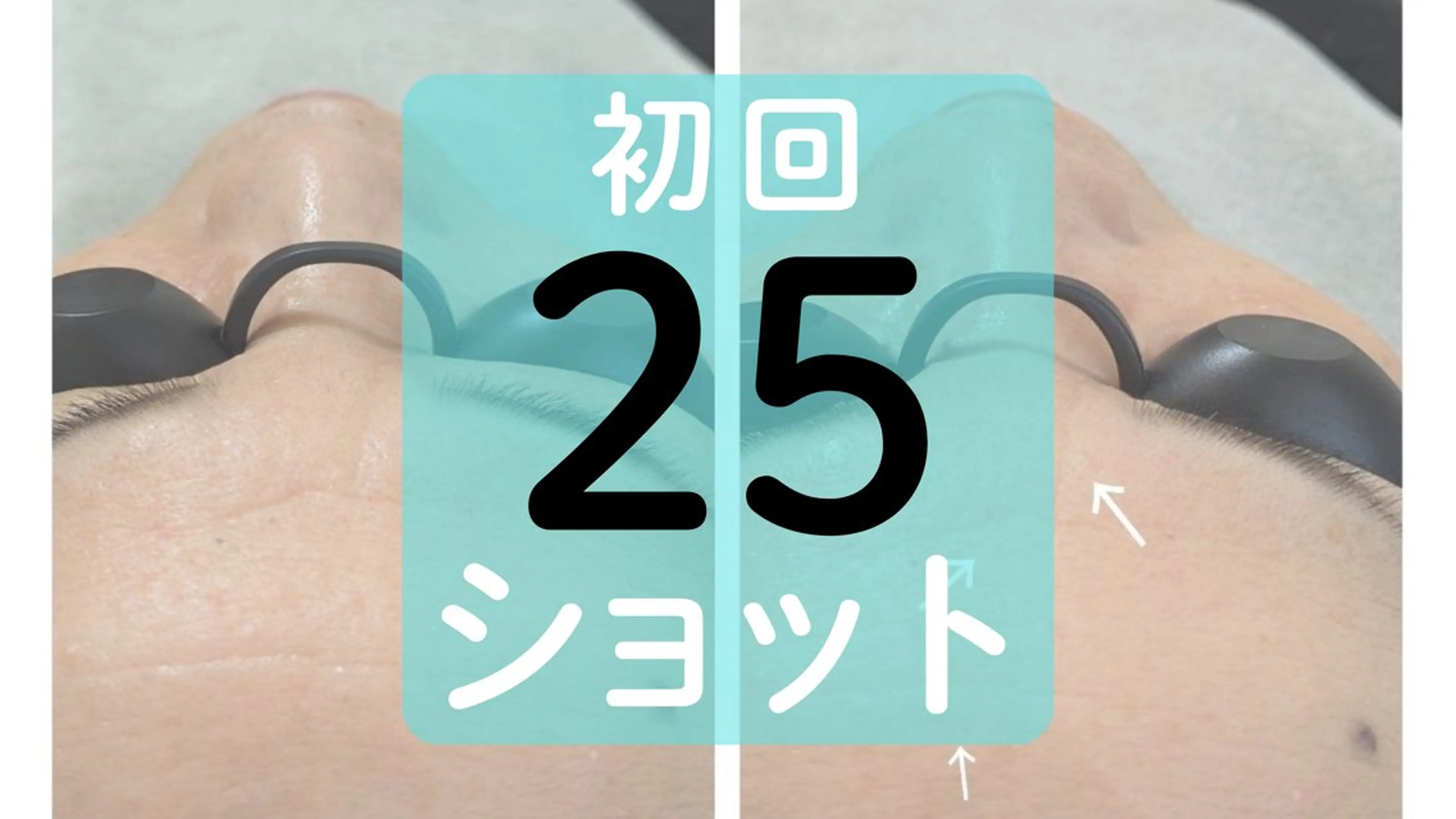 【初回価格】シワ・シミ・くすみなどお顔の部分ケアに 25ショットの写真