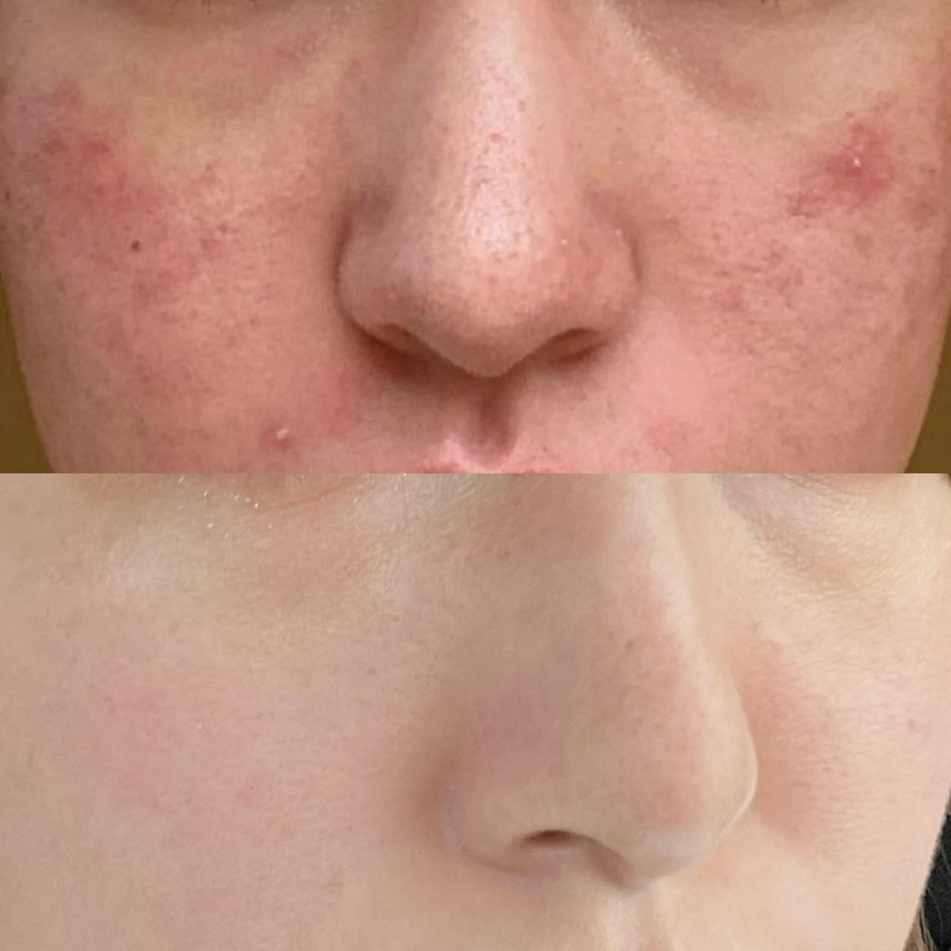 学生ニキビ改善🍀 優しい肌質改善のエステ・リラクイメージ