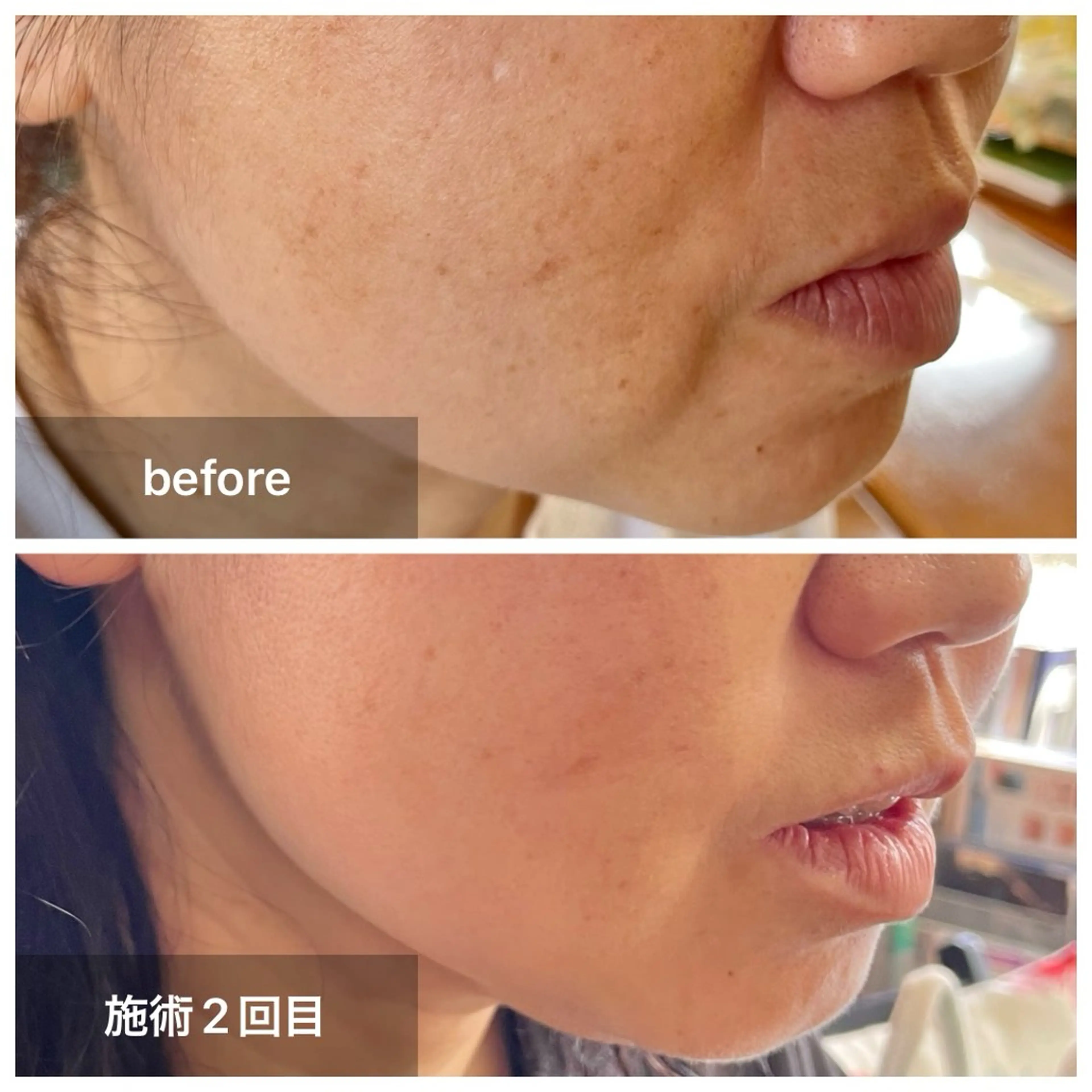 【デコルテ＋フェイスケア】ほうれい線、しわ、たるみ、肝斑、くすみ、乾燥等…すっきり小顔＆ふっくらバストに♪の写真