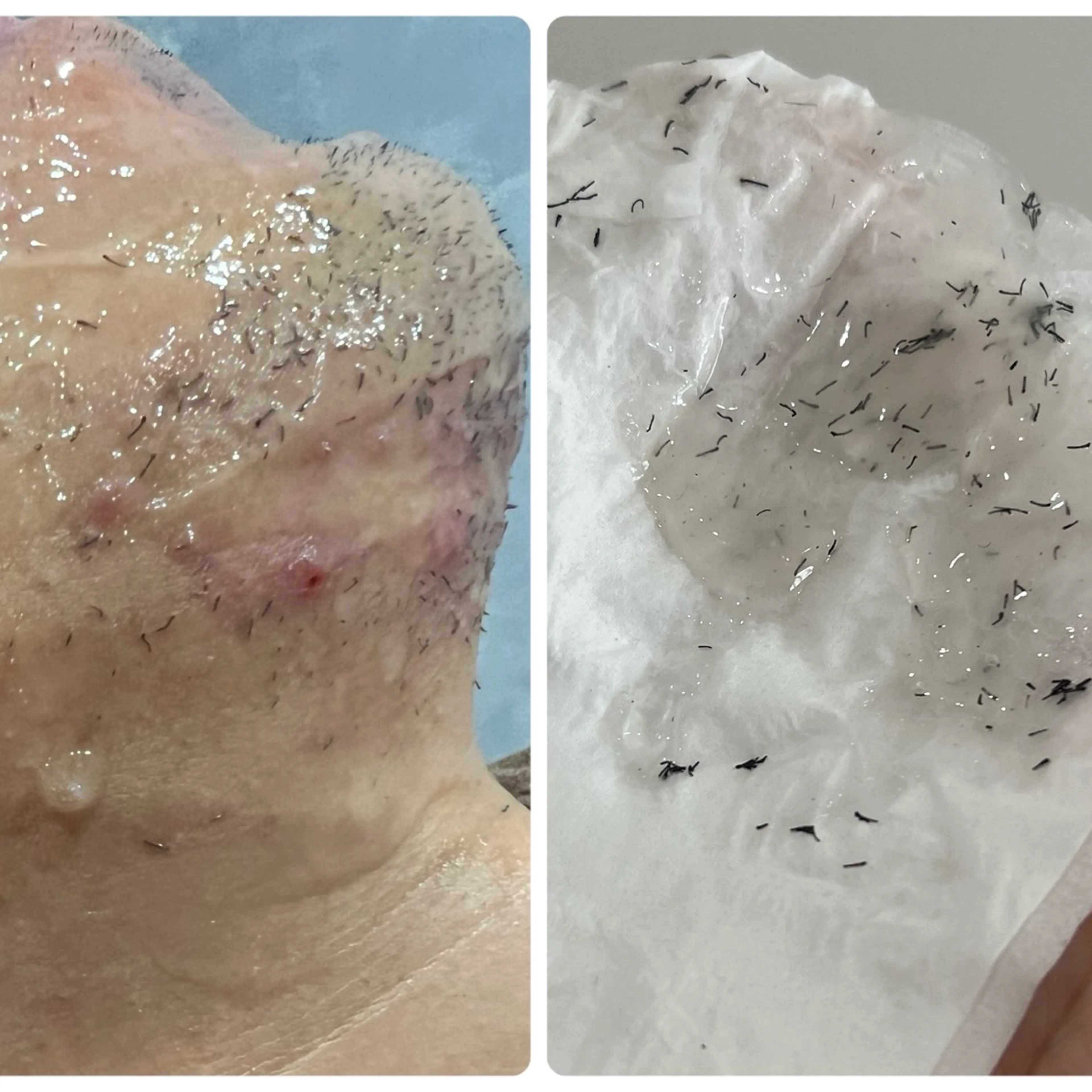 当日限定ゲリラクーポン【男性】脱毛期間もツルツルが続く˗ˋˏ  ヒゲ脱毛 ˎˊ˗通常¥5,500→¥1,000の写真