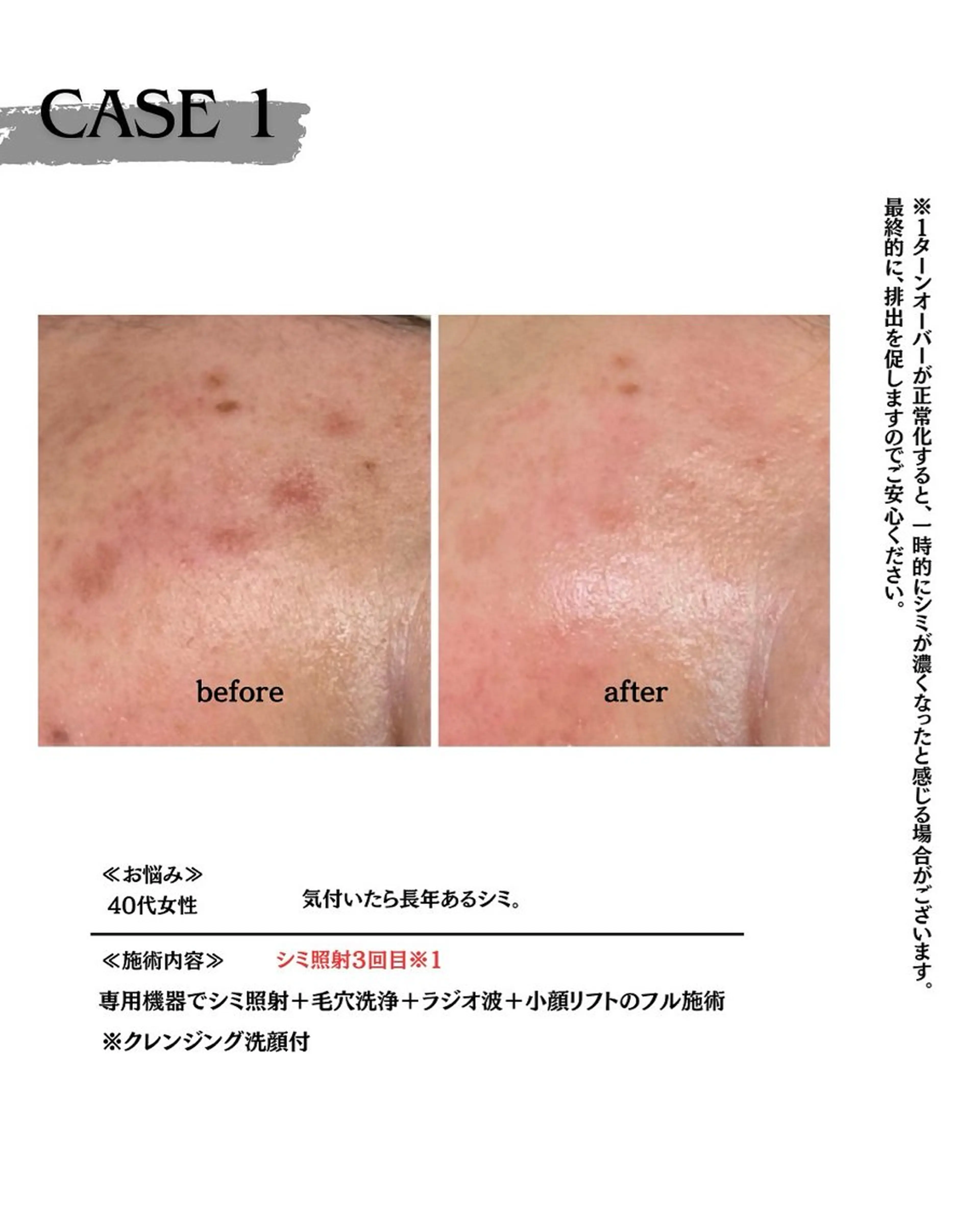 エステ 素肌育成・シミケア専門サロン美潤-miulu-所属・【医療提携サロン】 【シミケア専門】のエステ・リラクイメージ