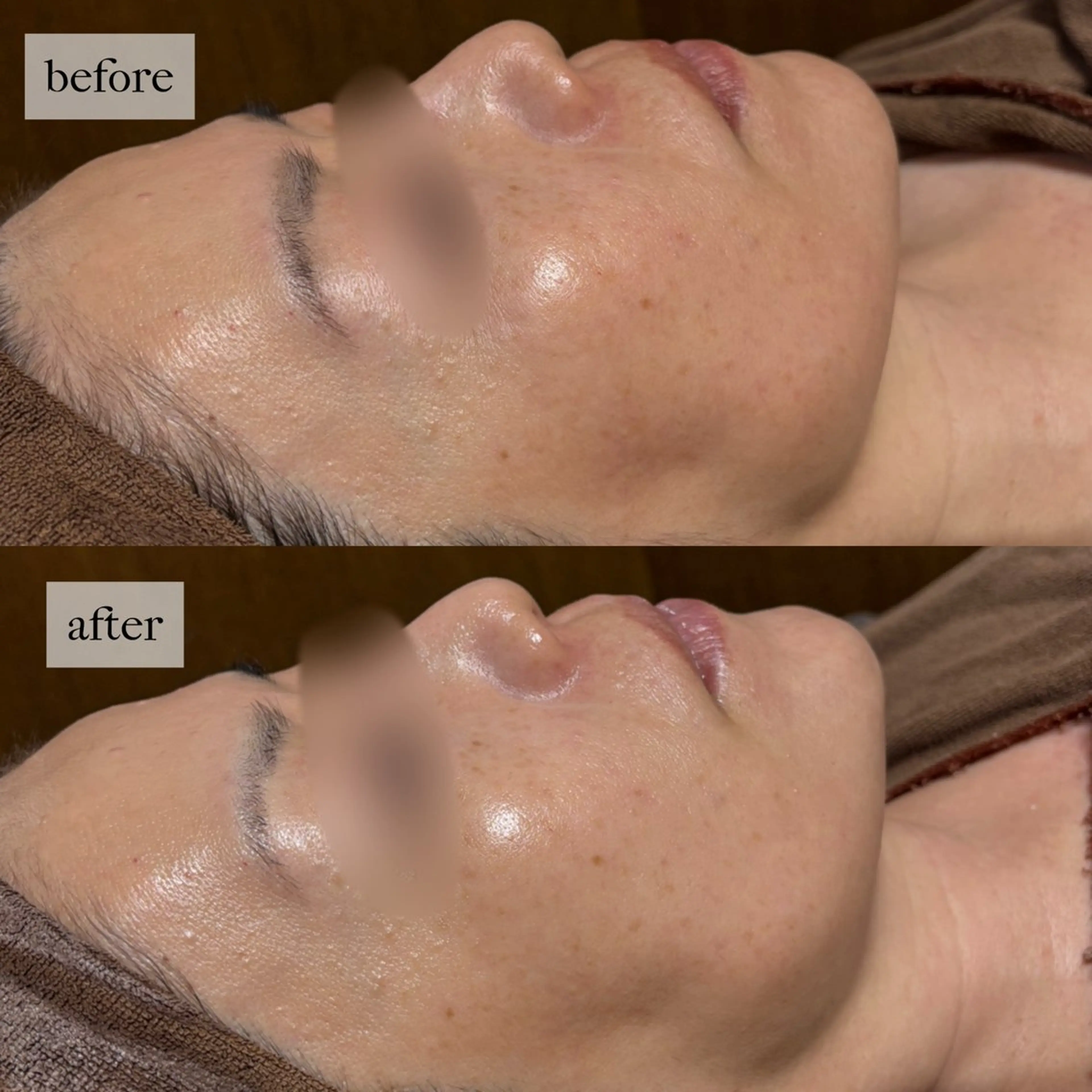 HINANO矢場町店【ヒナノ】所属・脱毛/肌改善🌿 HINANO 村田のエステ・リラクイメージ