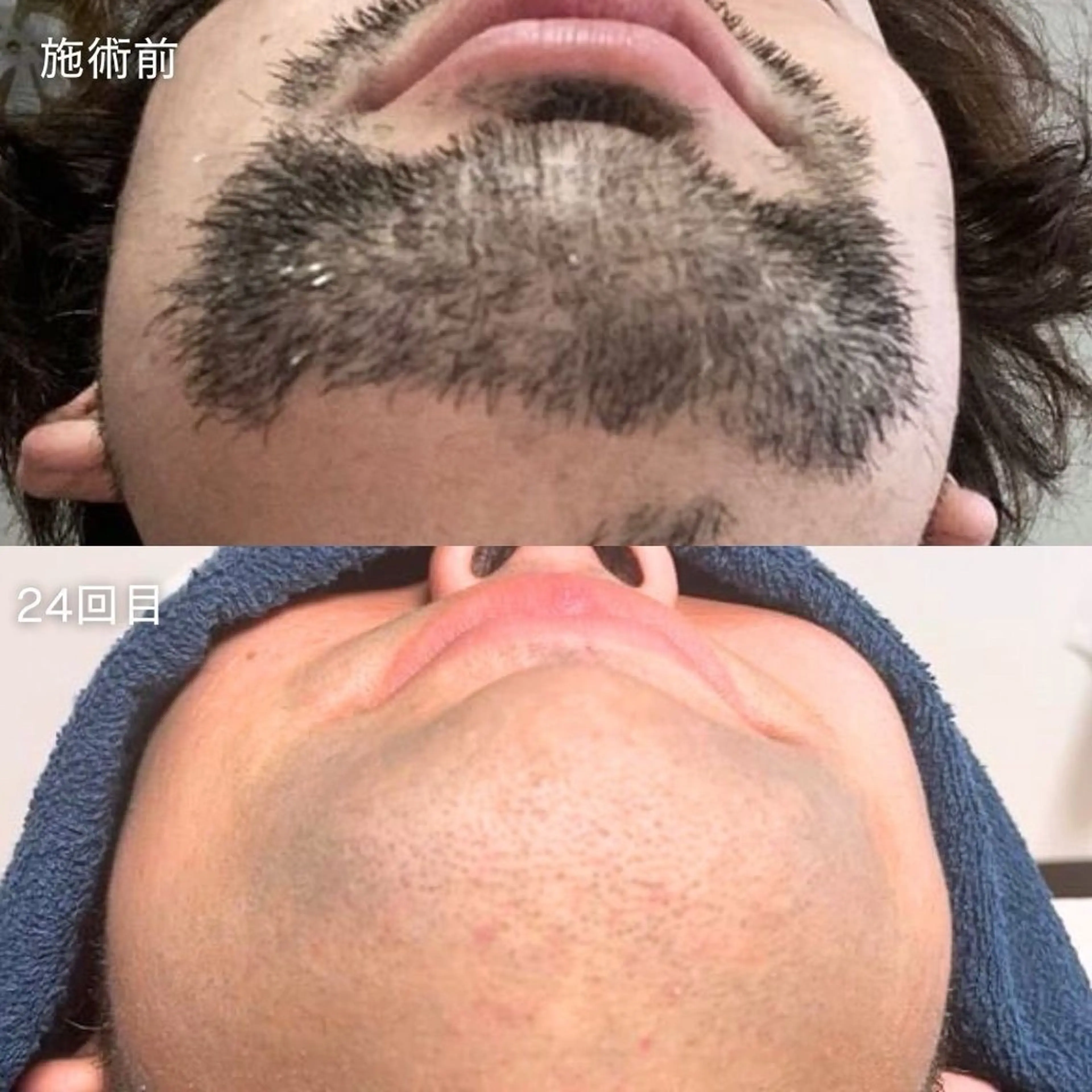 【男性】ヒゲ脱毛　初回キャンペーン価格の写真