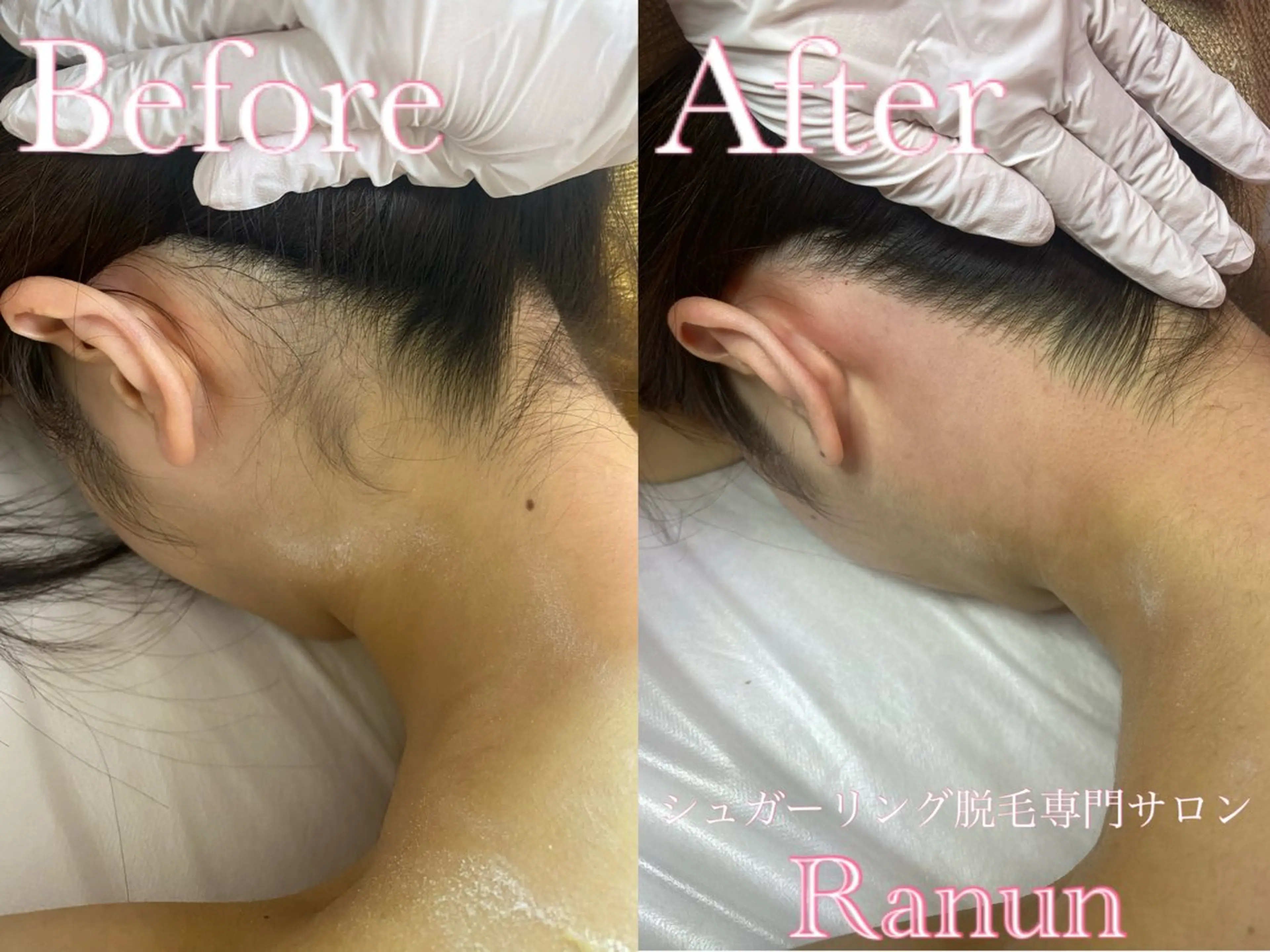 【垢抜け人気★No1】うなじ+もみあげ+デコルテ+脇+背中上 5点セットシュガーリング脱毛の写真