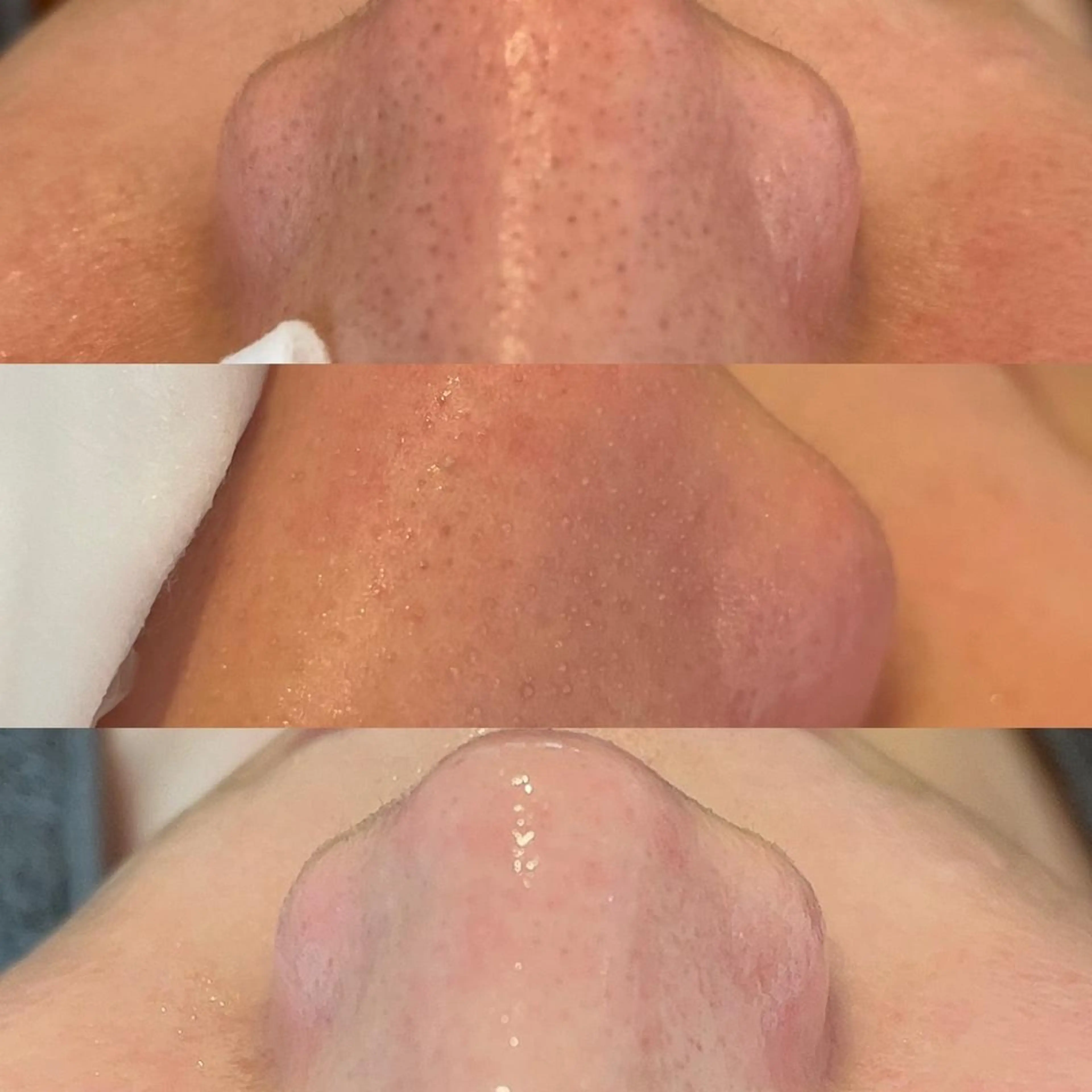 毛穴徹底洗浄コース👃の写真