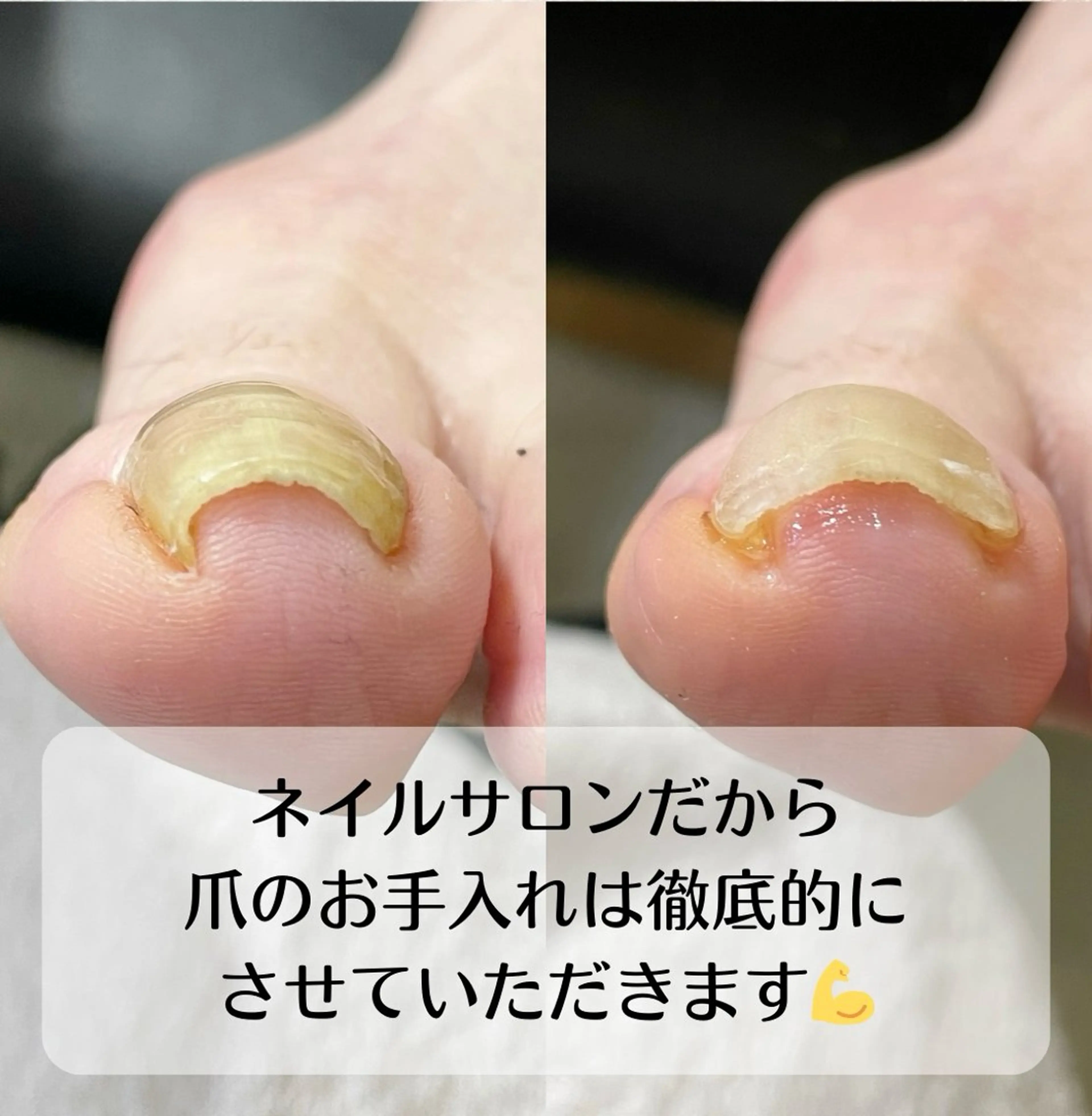 ネイル 深爪・巻き爪 専門サンセリテのネイルデザイン