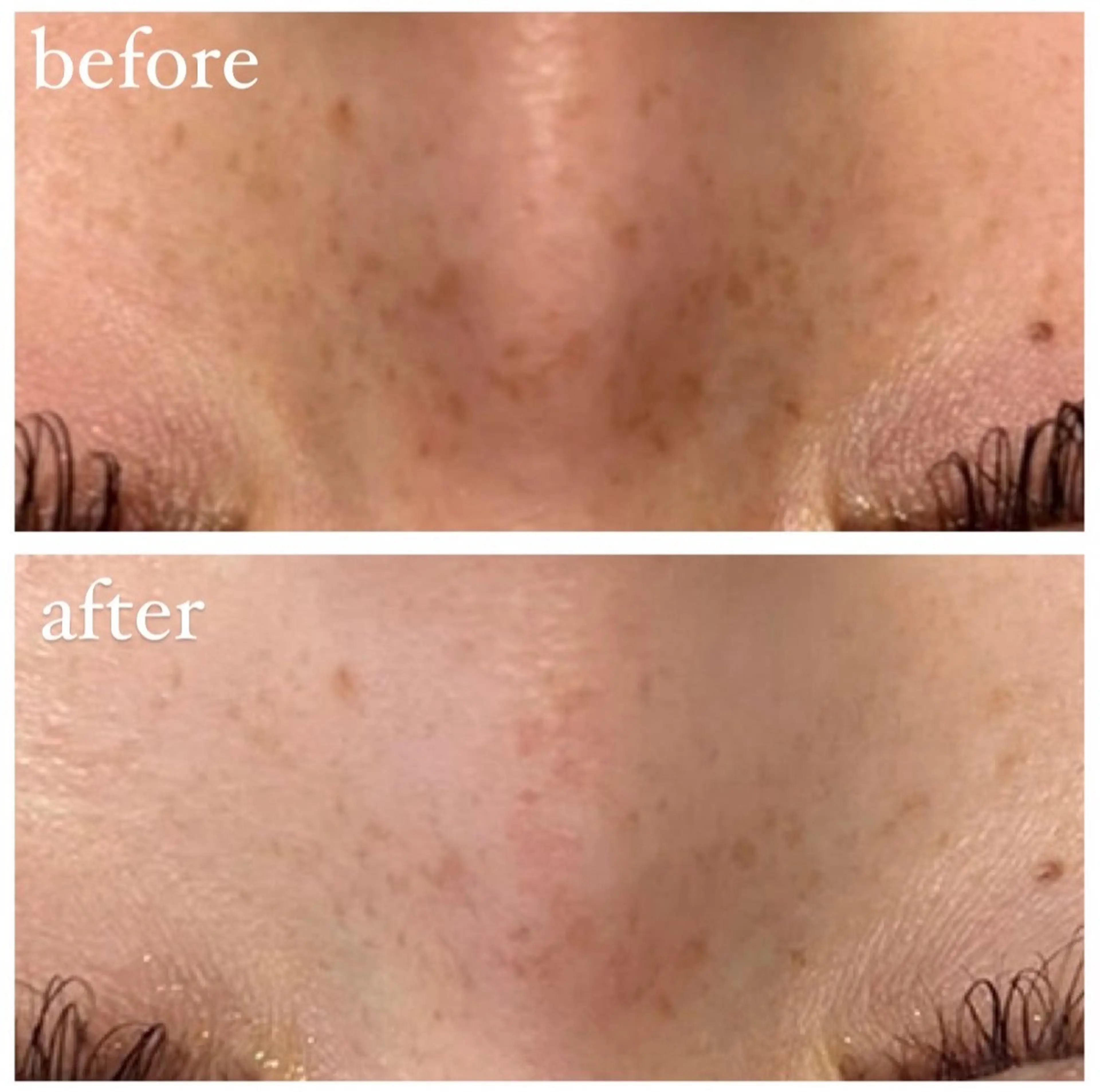 大人気❕ハーブピーリング🌿の写真