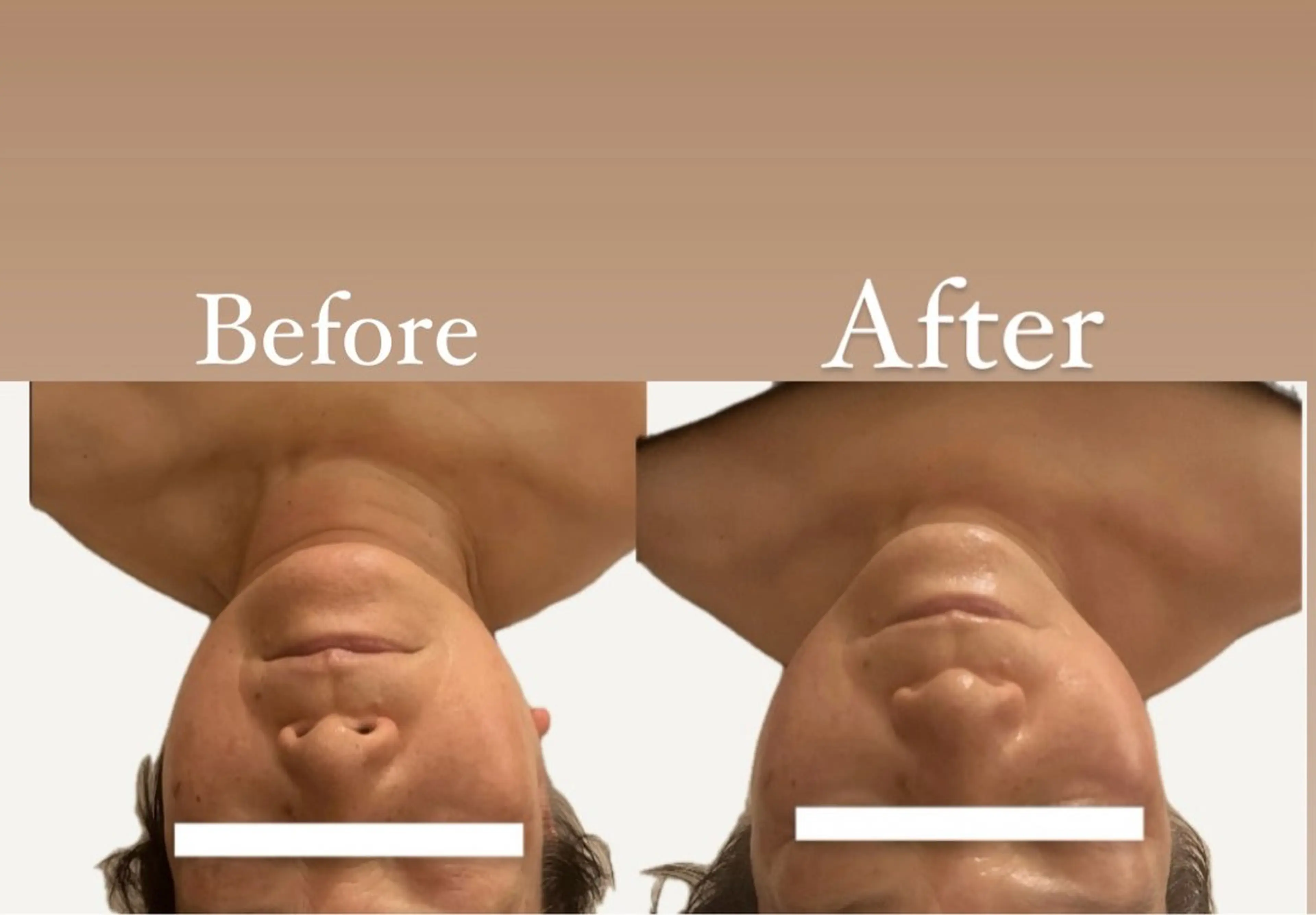 《小顔フェイシャル体験コース》　位置をグッと上に上がる⤴️  韓国発ラパ使用  男性ok 20分の写真