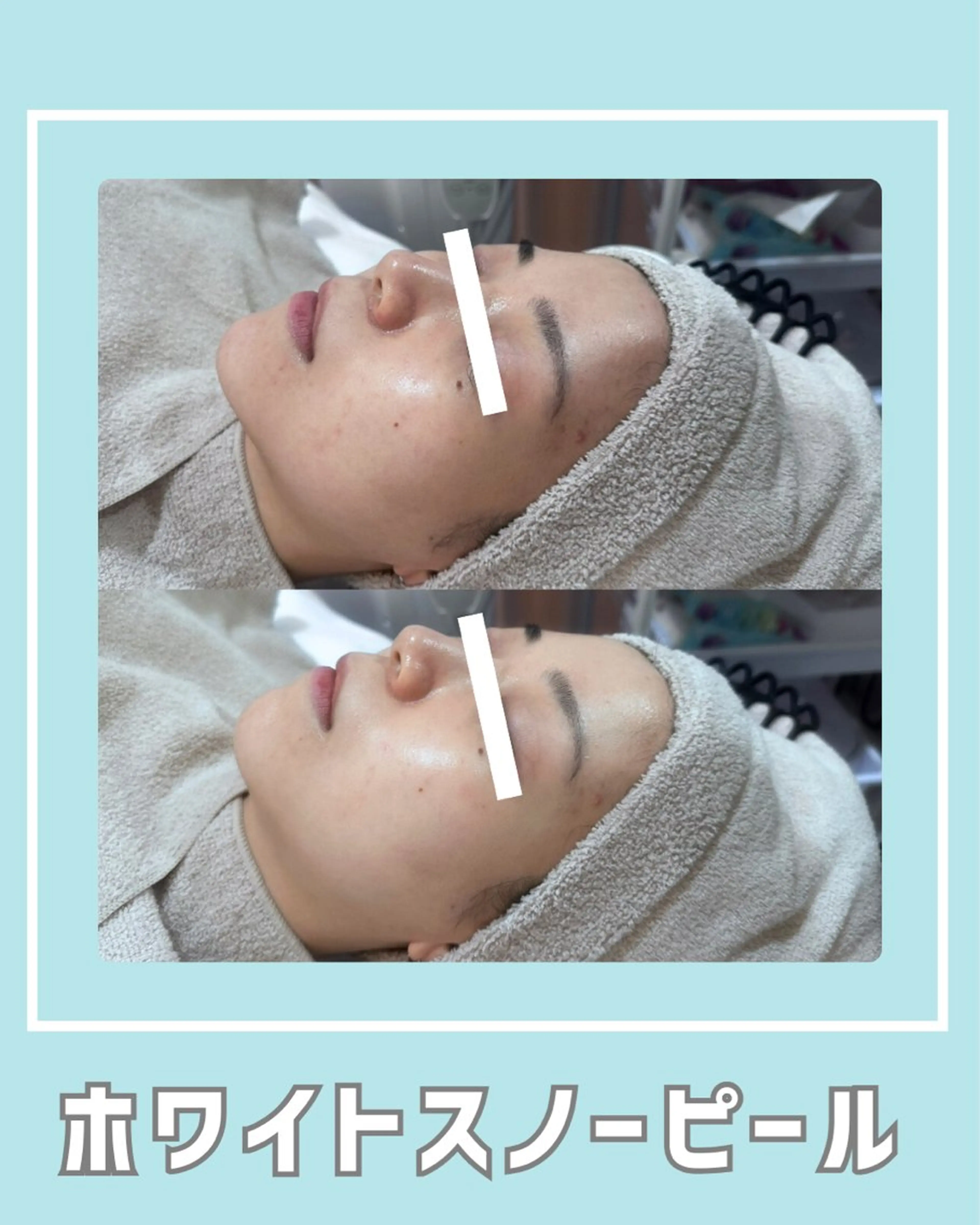 エステ |ピーリング・毛穴| soina神楽坂のエステ・リラクイメージ