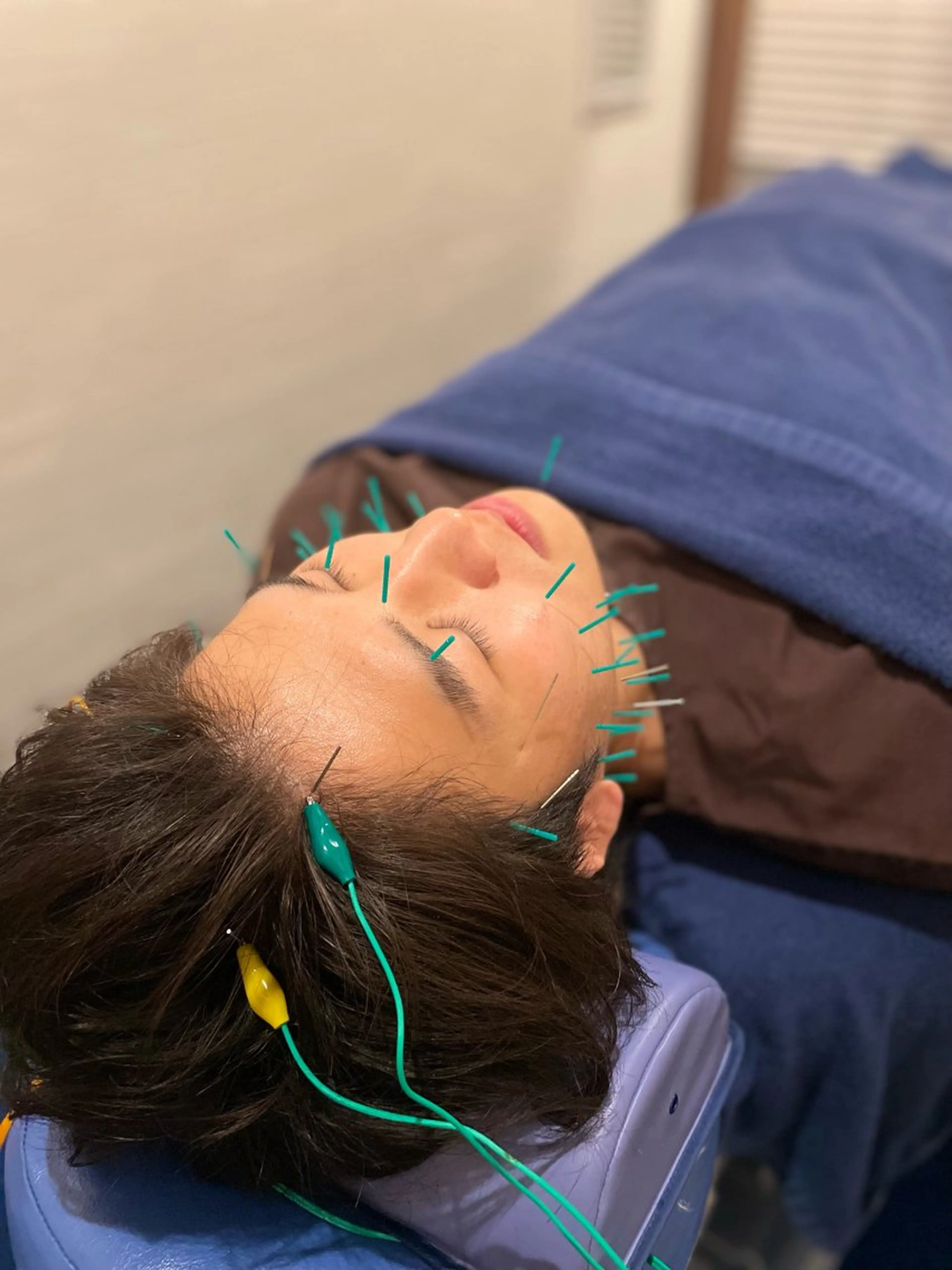 【浮腫みフェイス撃退🔥】小顔効果＋肌の回りも促進◎お顔集中ケアメニュー45分(美容鍼＋微弱電流)の写真