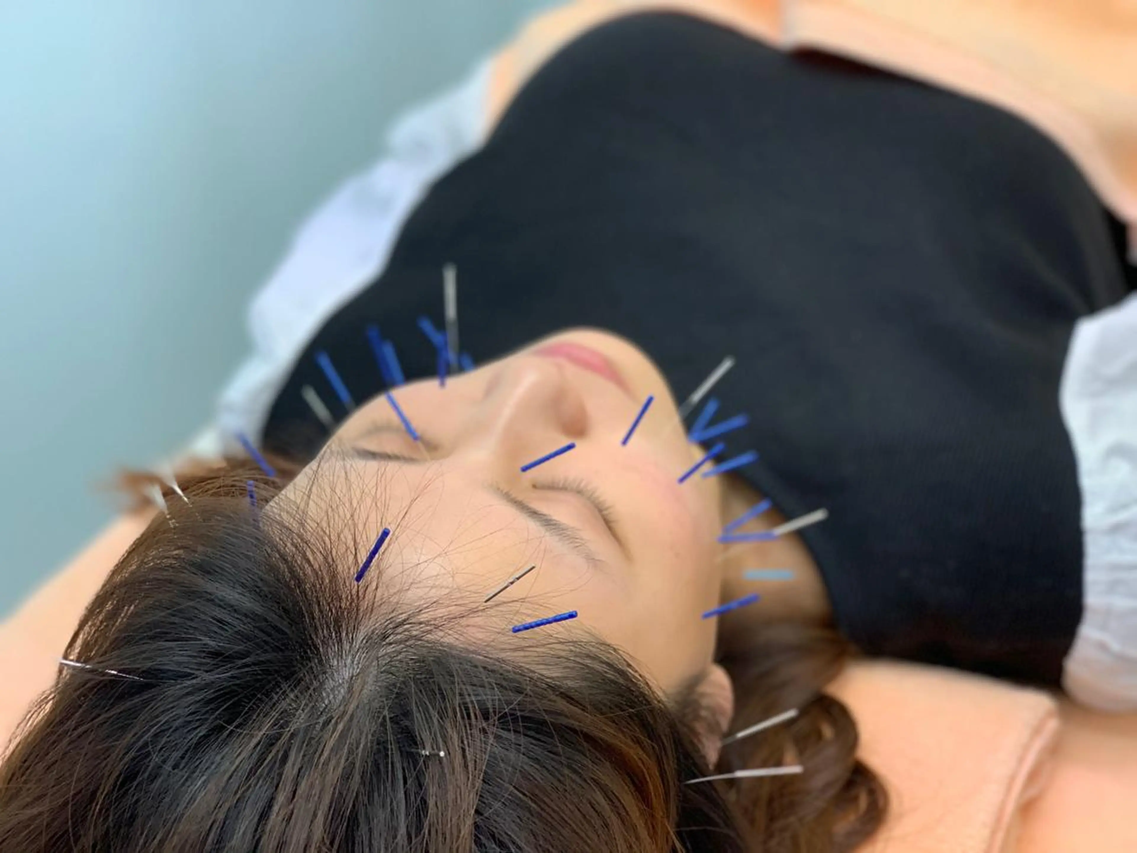 【まずはお試ししてみたい!】KOBAYASHI式美容鍼🥰の写真
