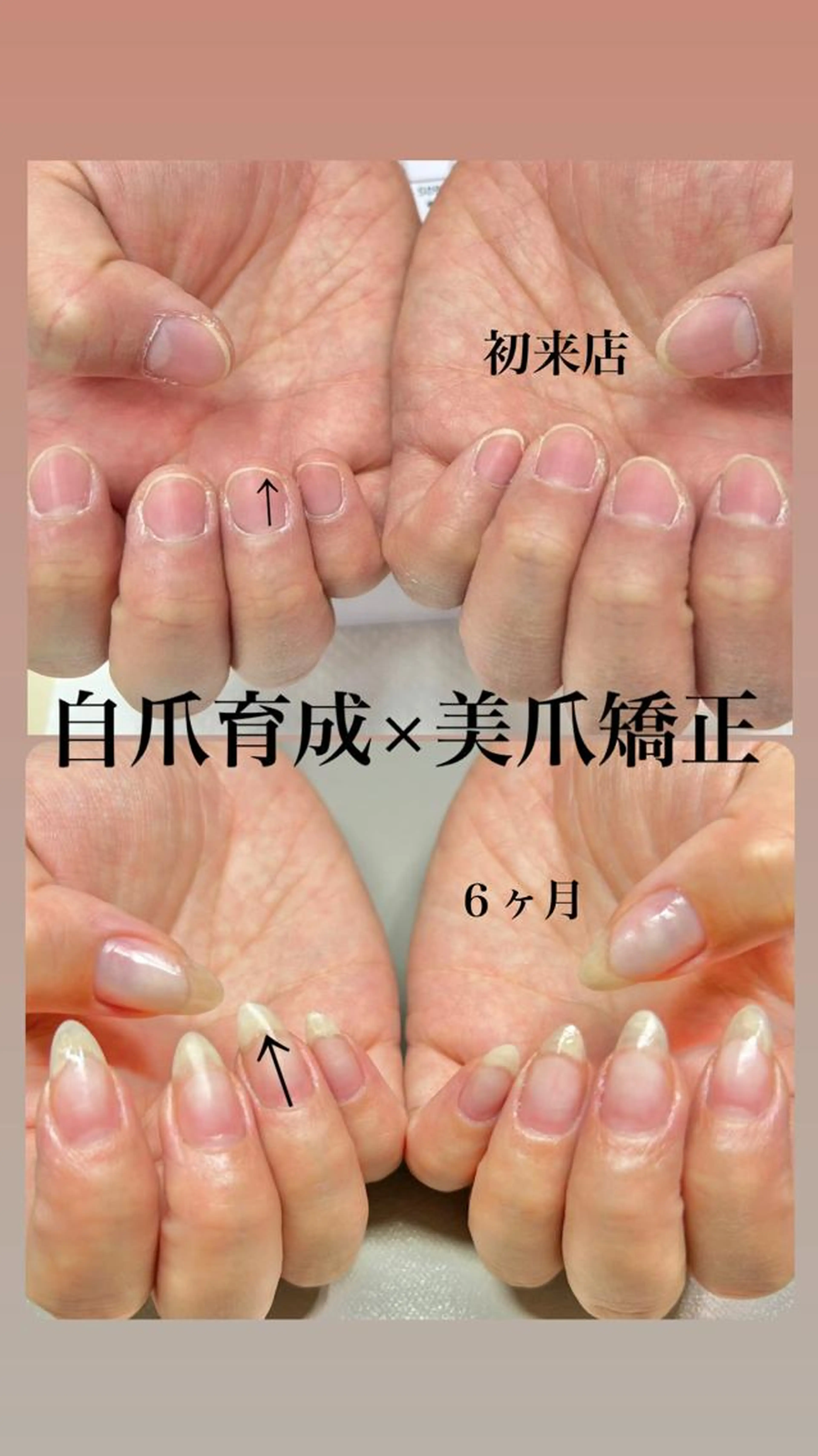 当店イチオシ✨ネイルリアイング(自爪育成×美爪矯正)の写真
