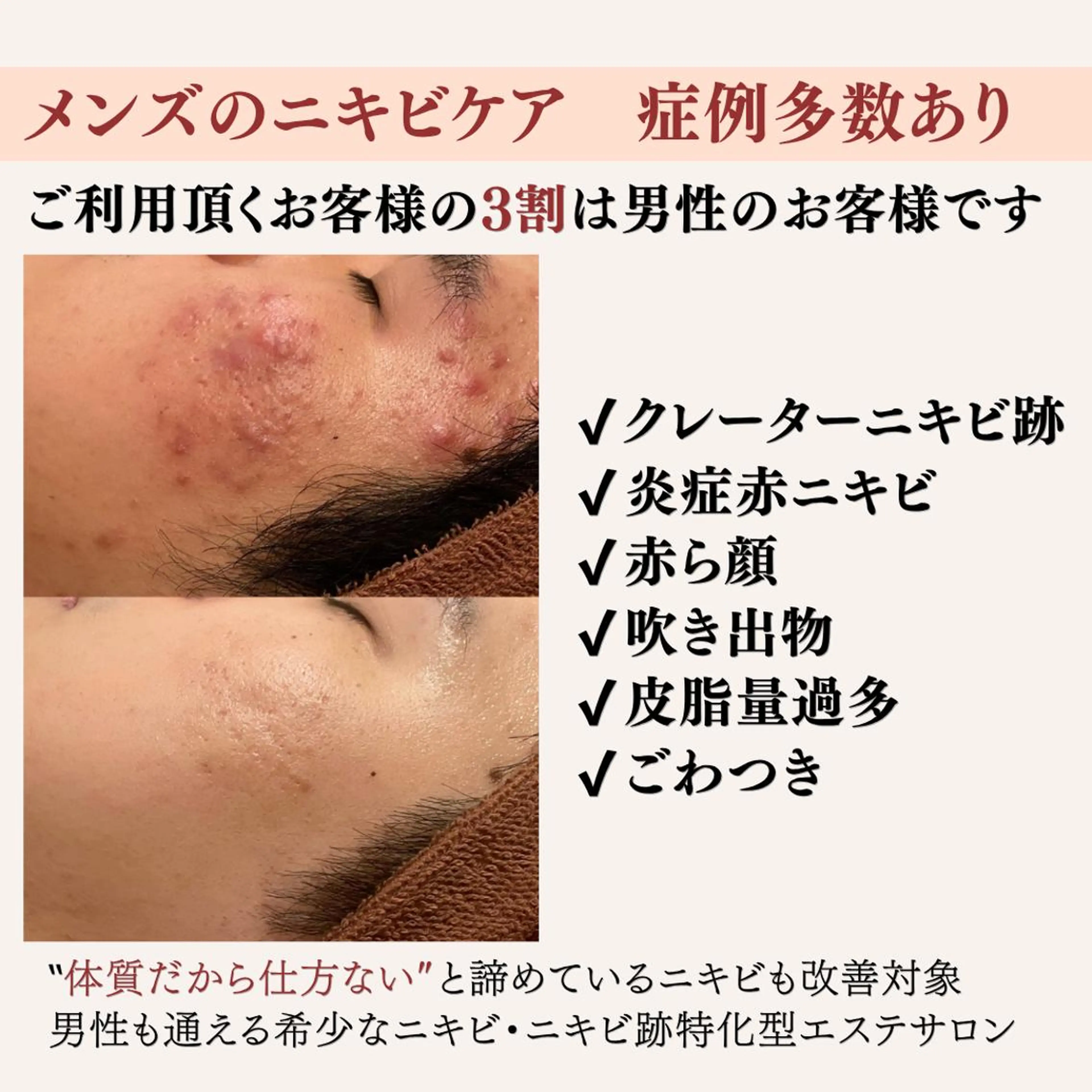 重度ニキビ専門🌷 ダウンタイムなしのエステ・リラクイメージ