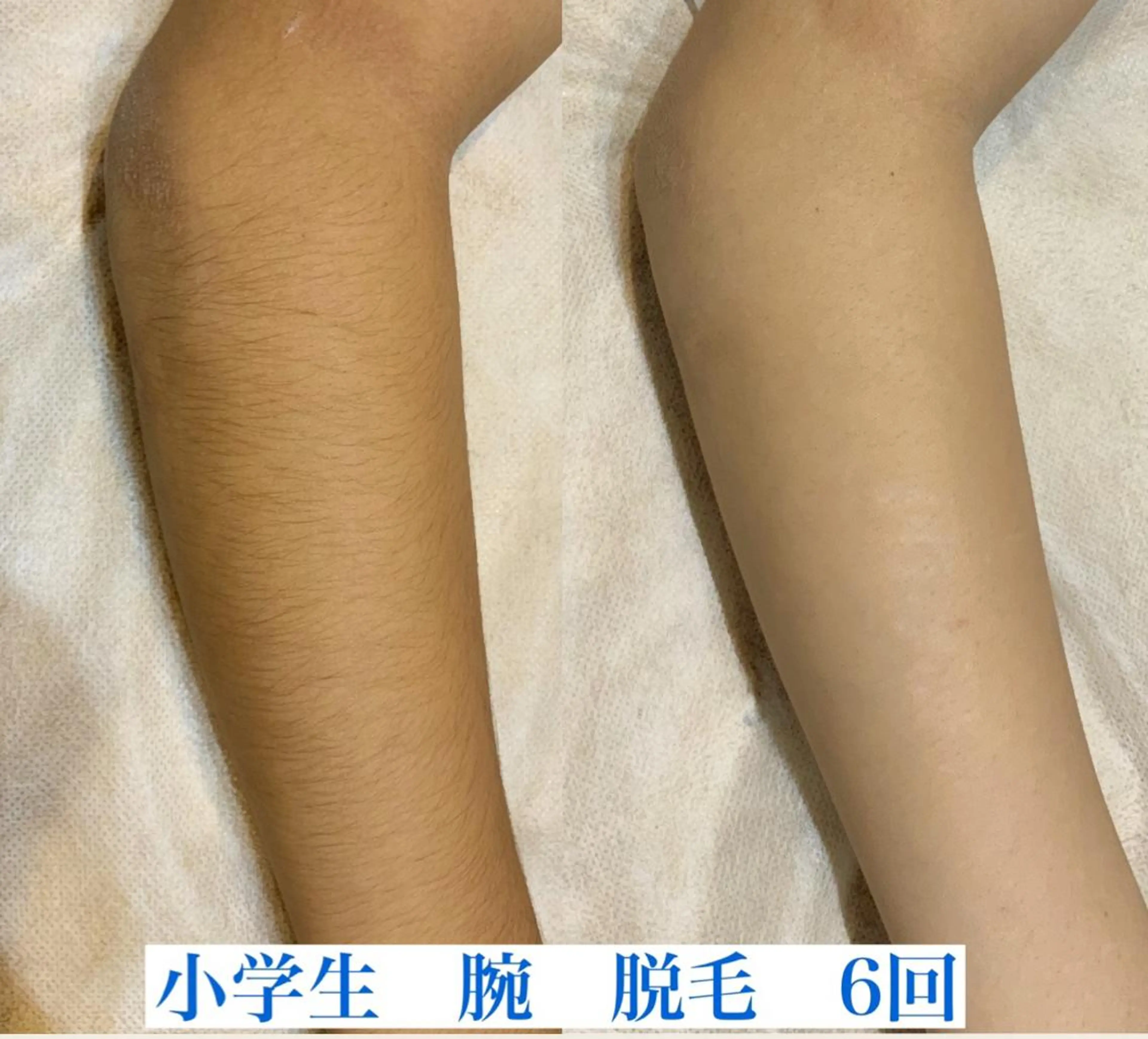 【キッズ脱毛】腕+脚脱毛　（肘下膝下になります）の写真