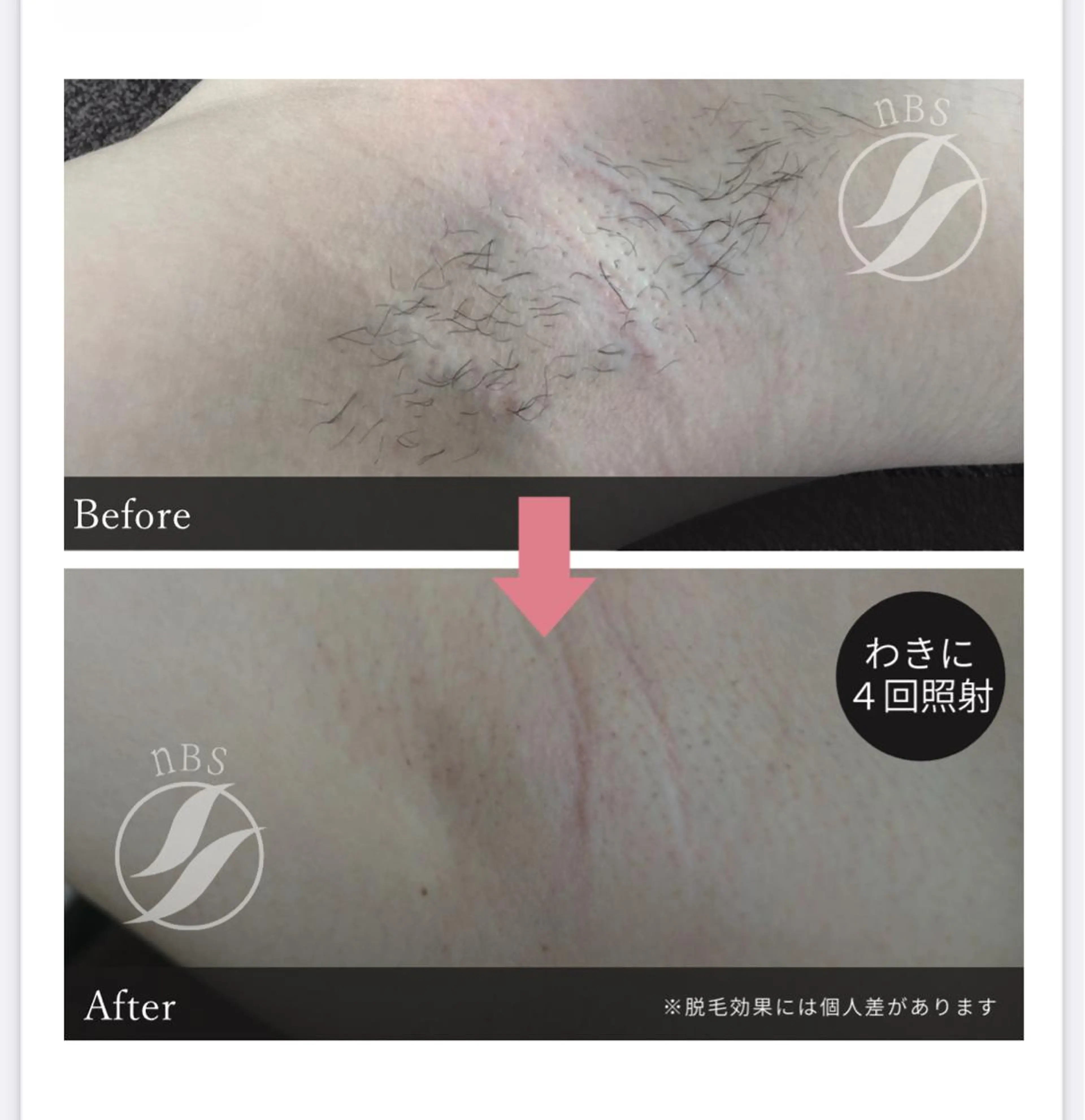 初回 THR方式 ワキ脱毛 ¥3,500→¥2,500 一度で効果が現れる人も多数…  メンズも🆗の写真