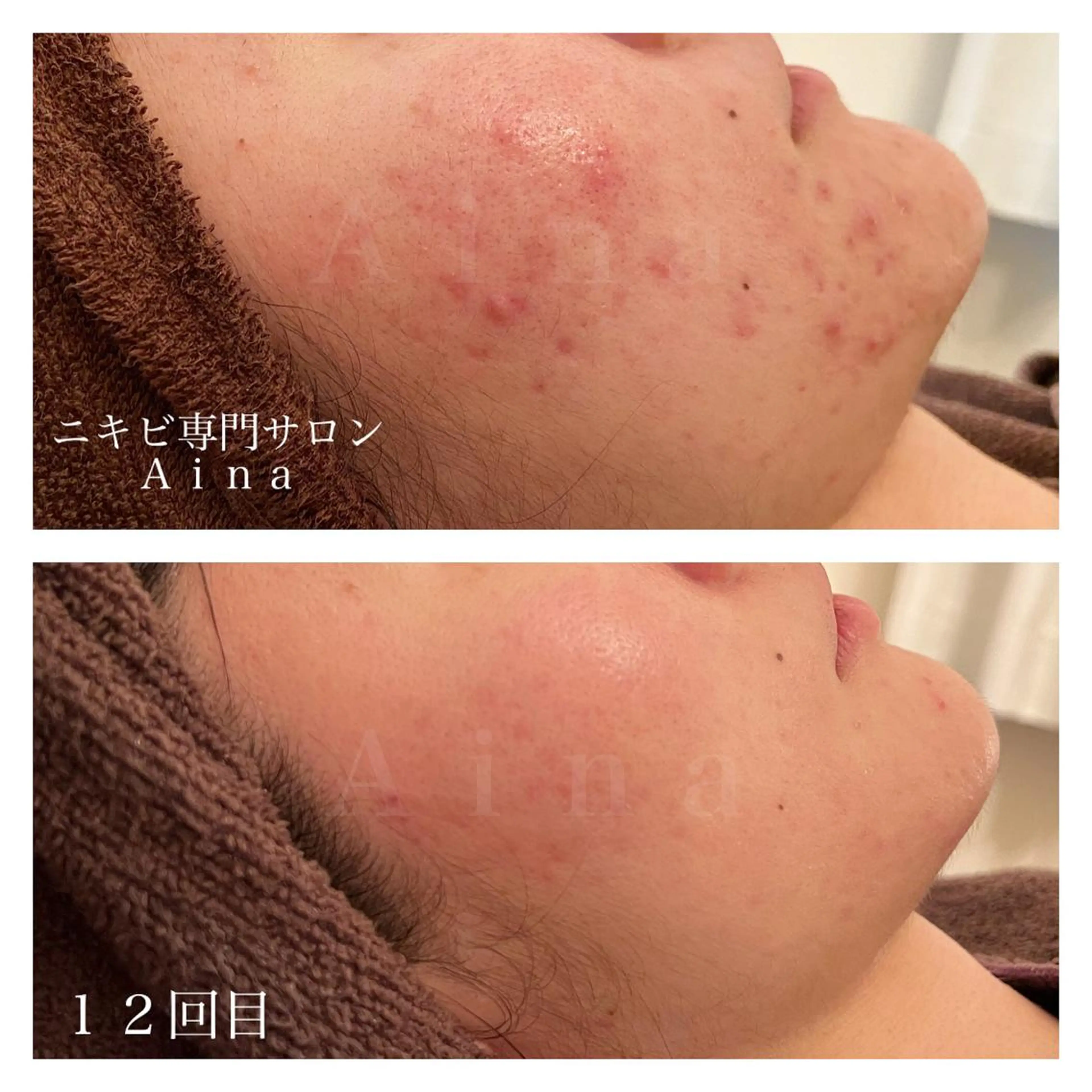 セミロング パーマ ヘアアレンジ メンズ キッズ ネイル マツエク・マツパ 赤色 エステ リラク ニキビ跡専門サロン Ａｉｎａのエステ・リラクイメージ