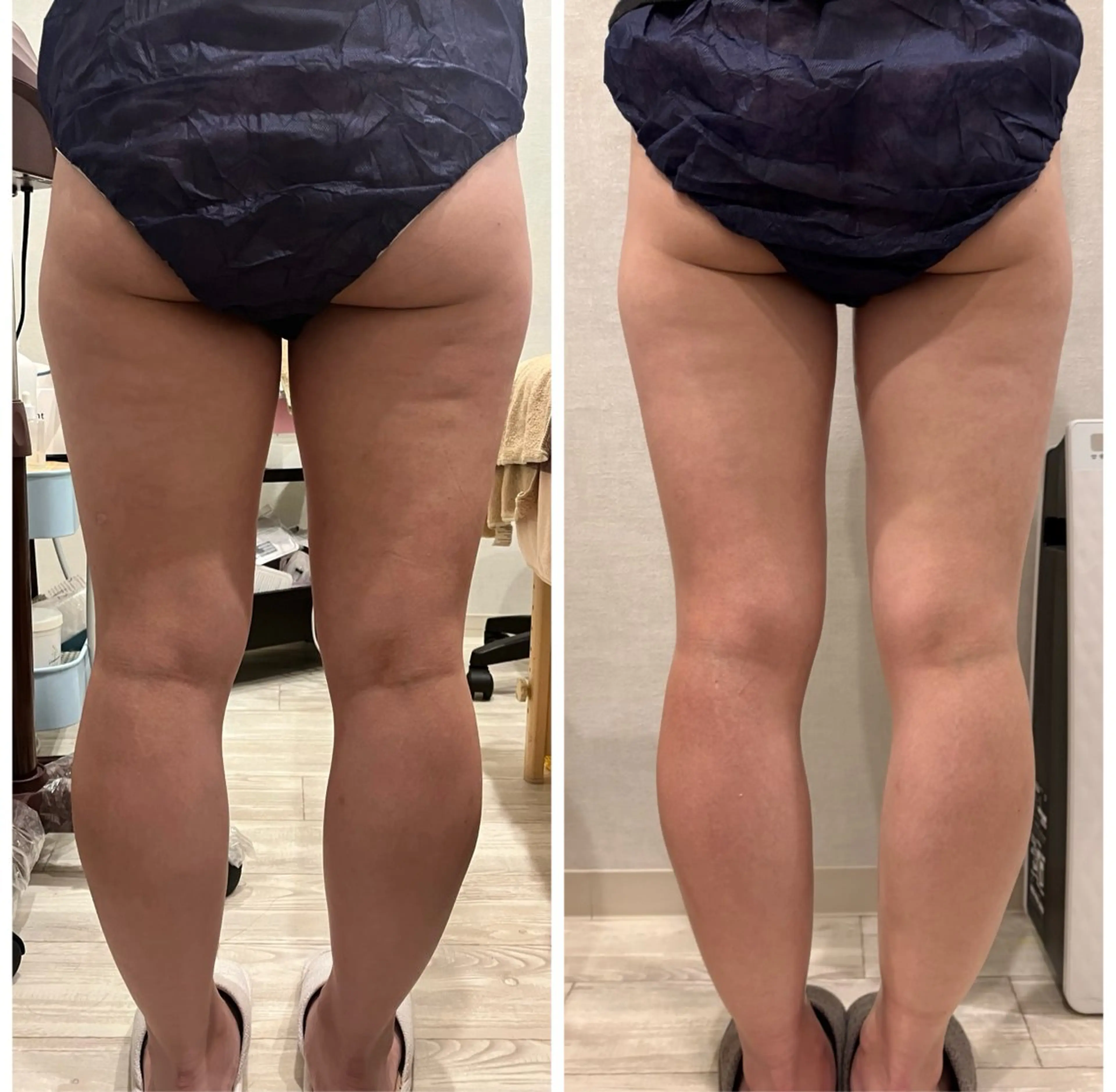 【夏までに本気痩せ】《冬の痩せやすい時期に♪》痩身エステ1部位の写真