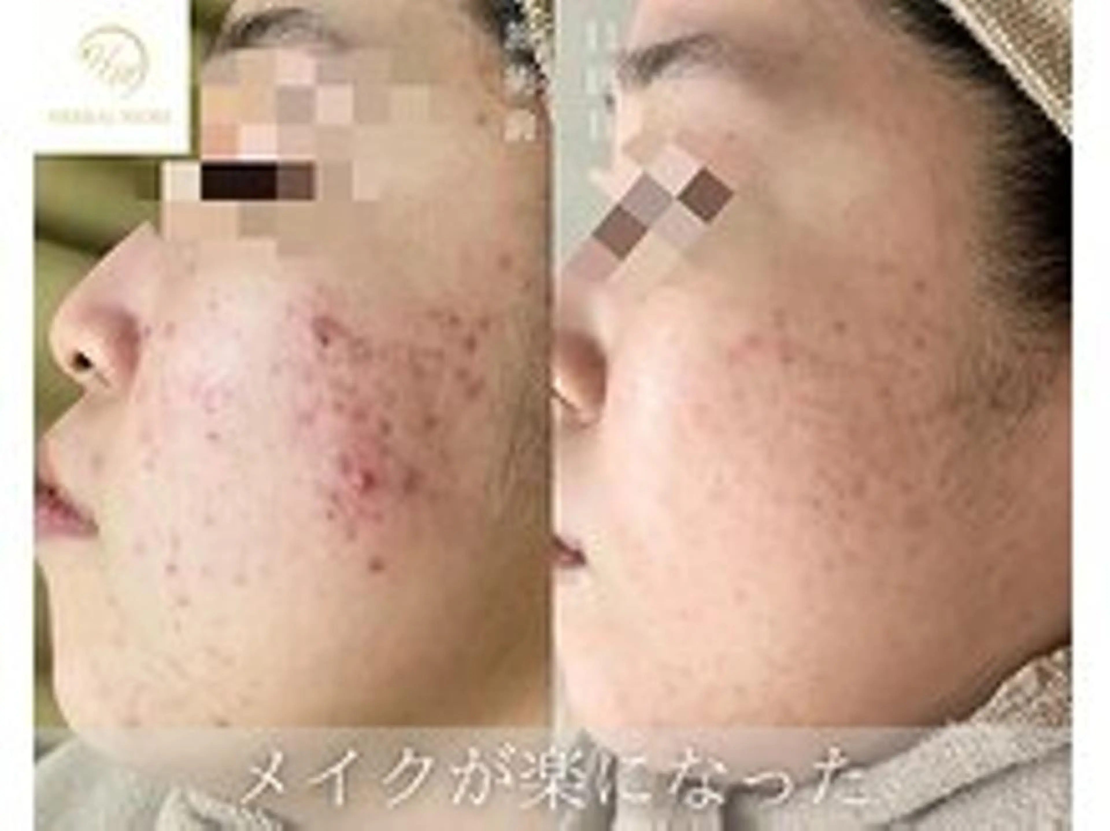 人気No.1【ニキビ/凸凹肌が気になる方】剥けるハーブピーリング＋鎮静パックの写真