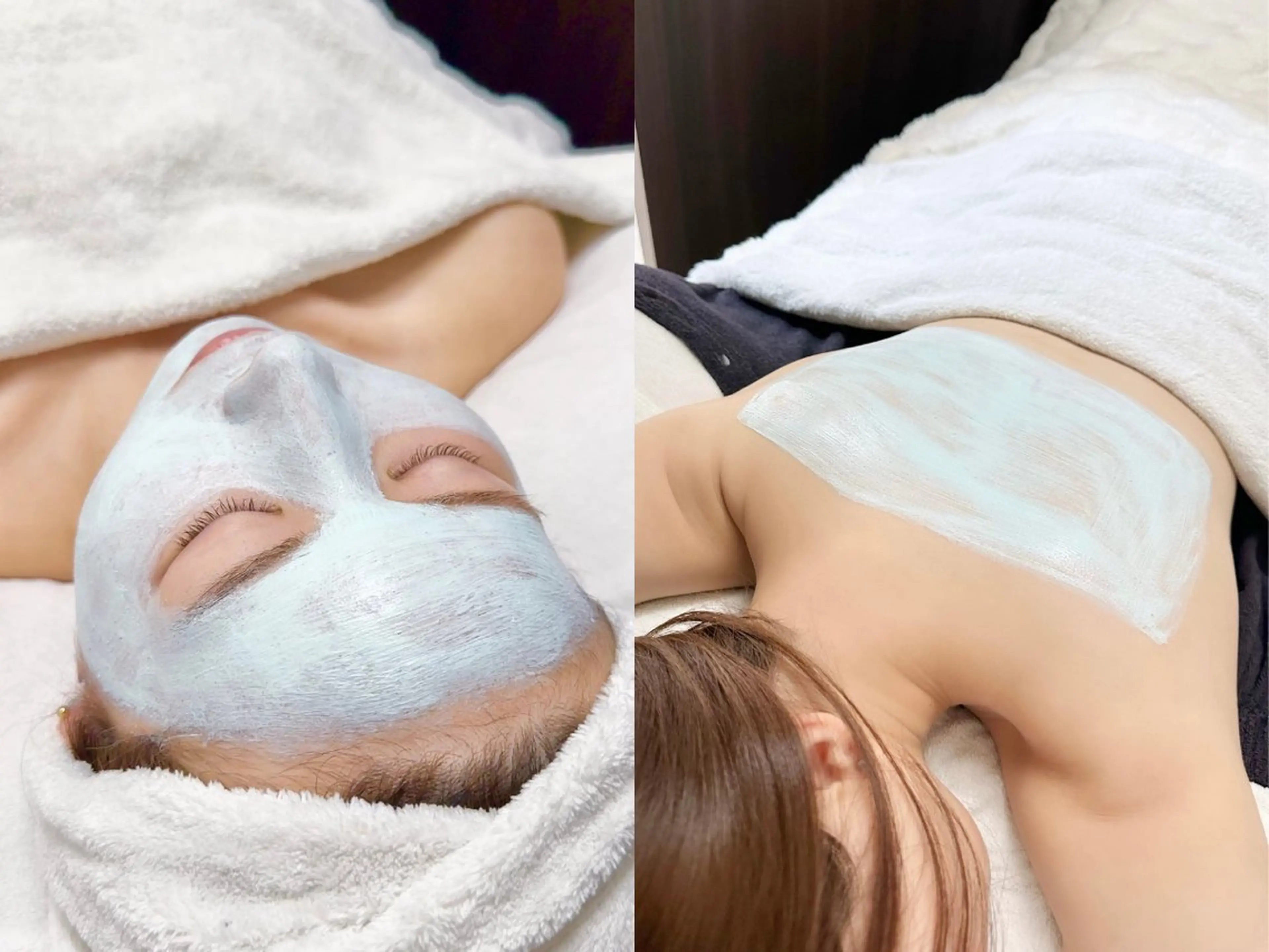 【口コミ割メニュー】《繰り返しニキビ・炎症鎮静》乳酸菌ピーリング｜顔or背中の写真