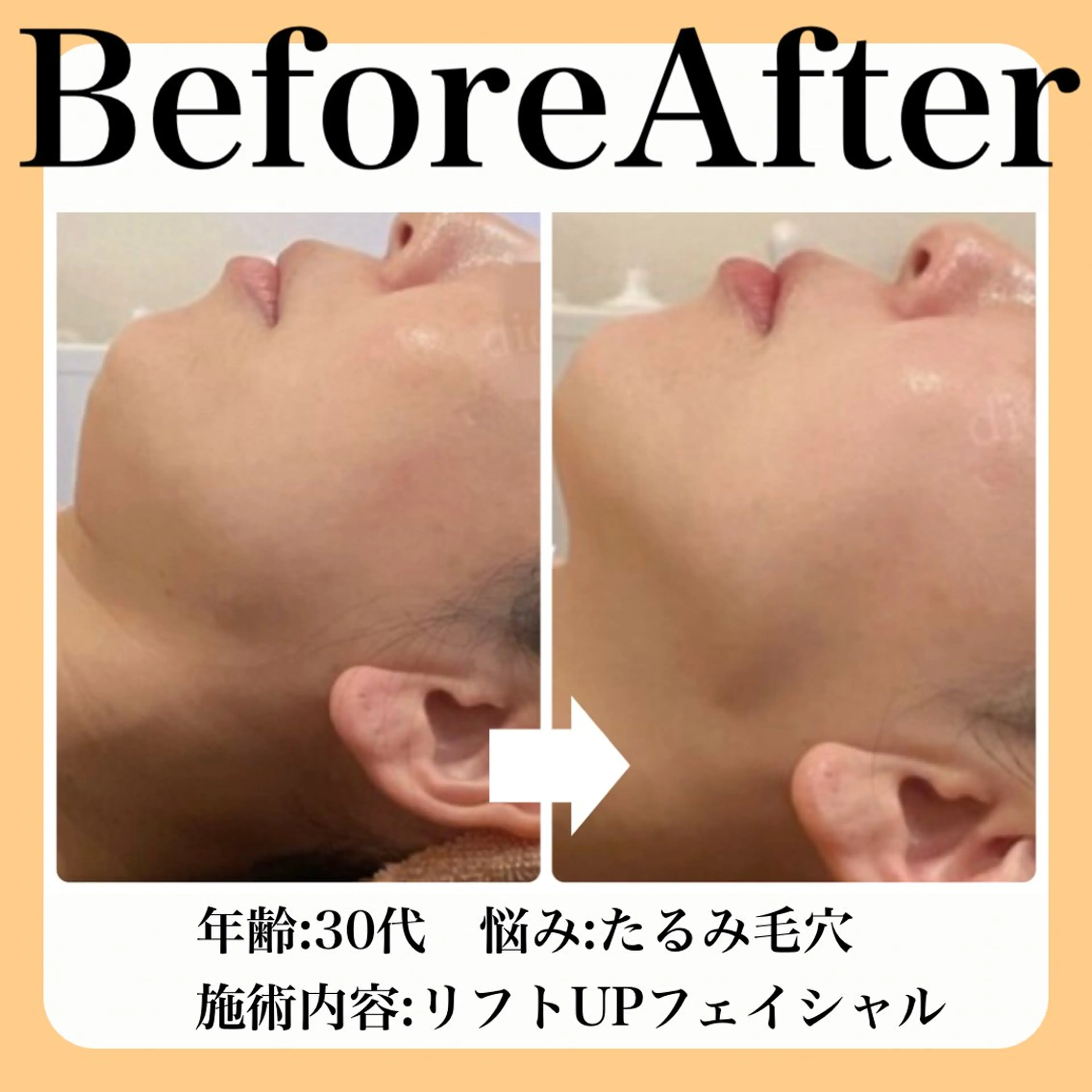 エステ 毛穴・たるみ･ニキビケア専門サロンsui所属・sui【スイ】 ARISAのエステ・リラクイメージ