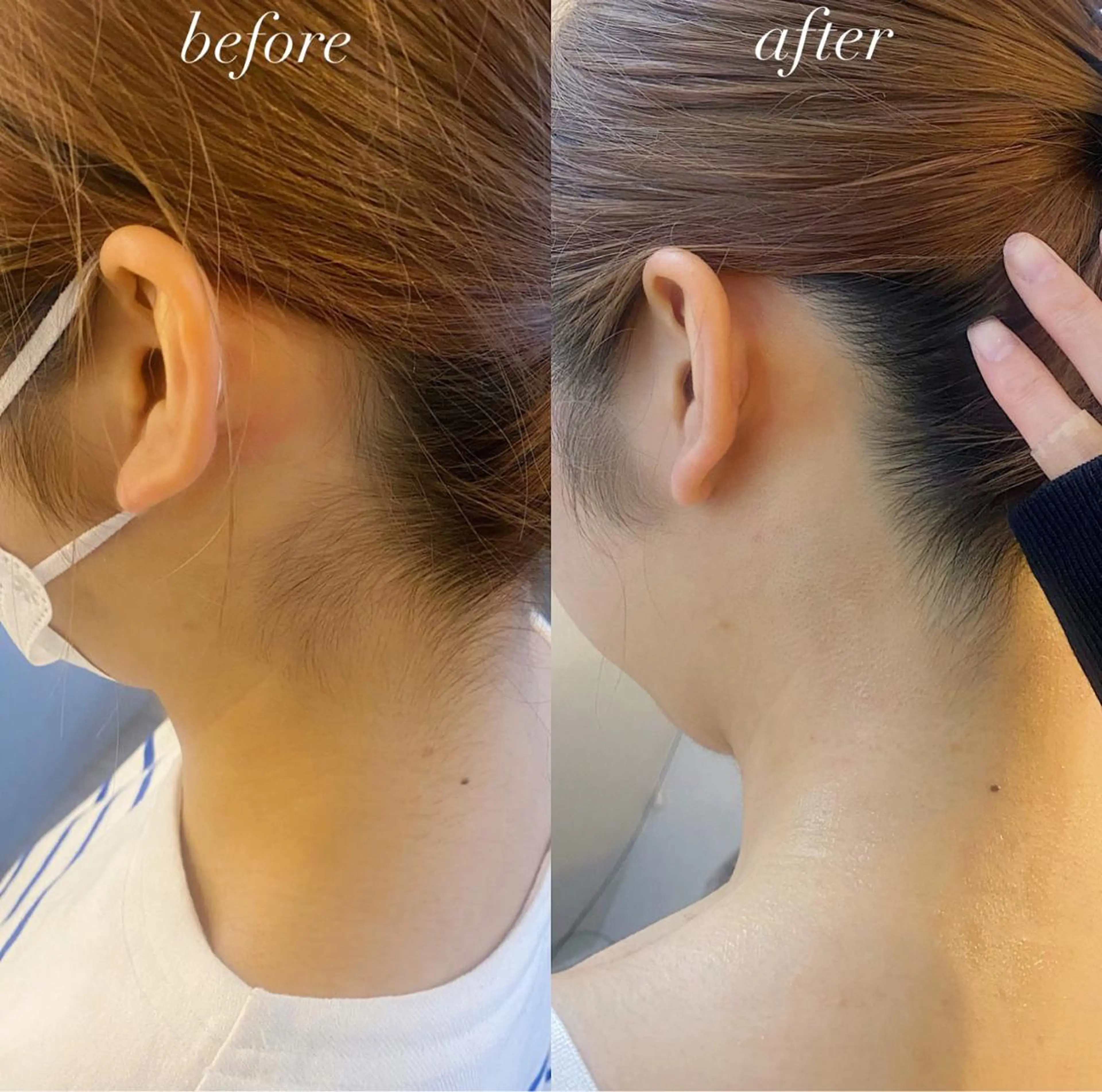 うなじ脱毛/美肌脱毛 LABELのエステ・リラクイメージ