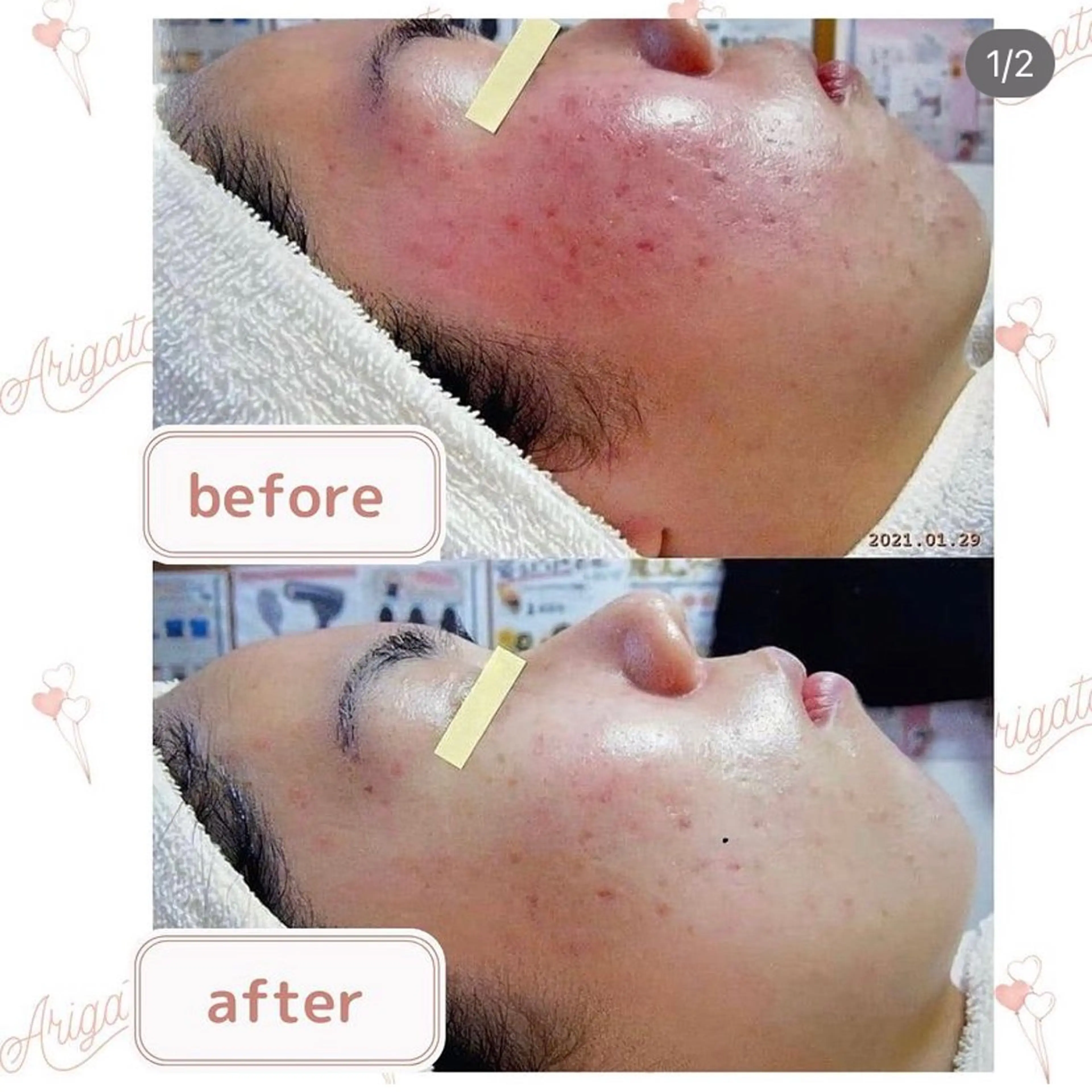 ニキビケア◇ニキビ跡 レゾン京橋店　八崎のエステ・リラクイメージ