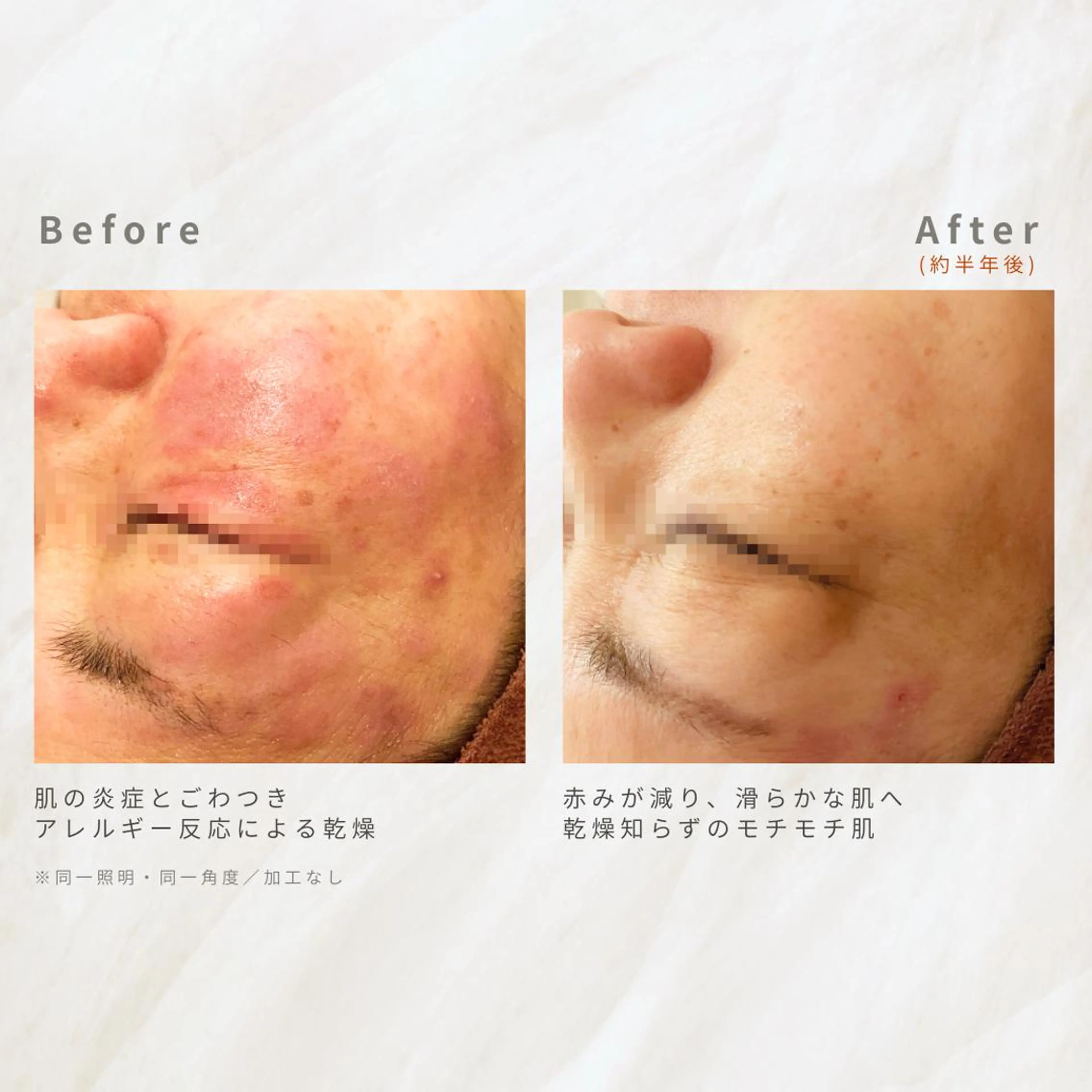 繰り返すニキビを改善 ✨つくば肌質改善専門のエステ・リラクイメージ