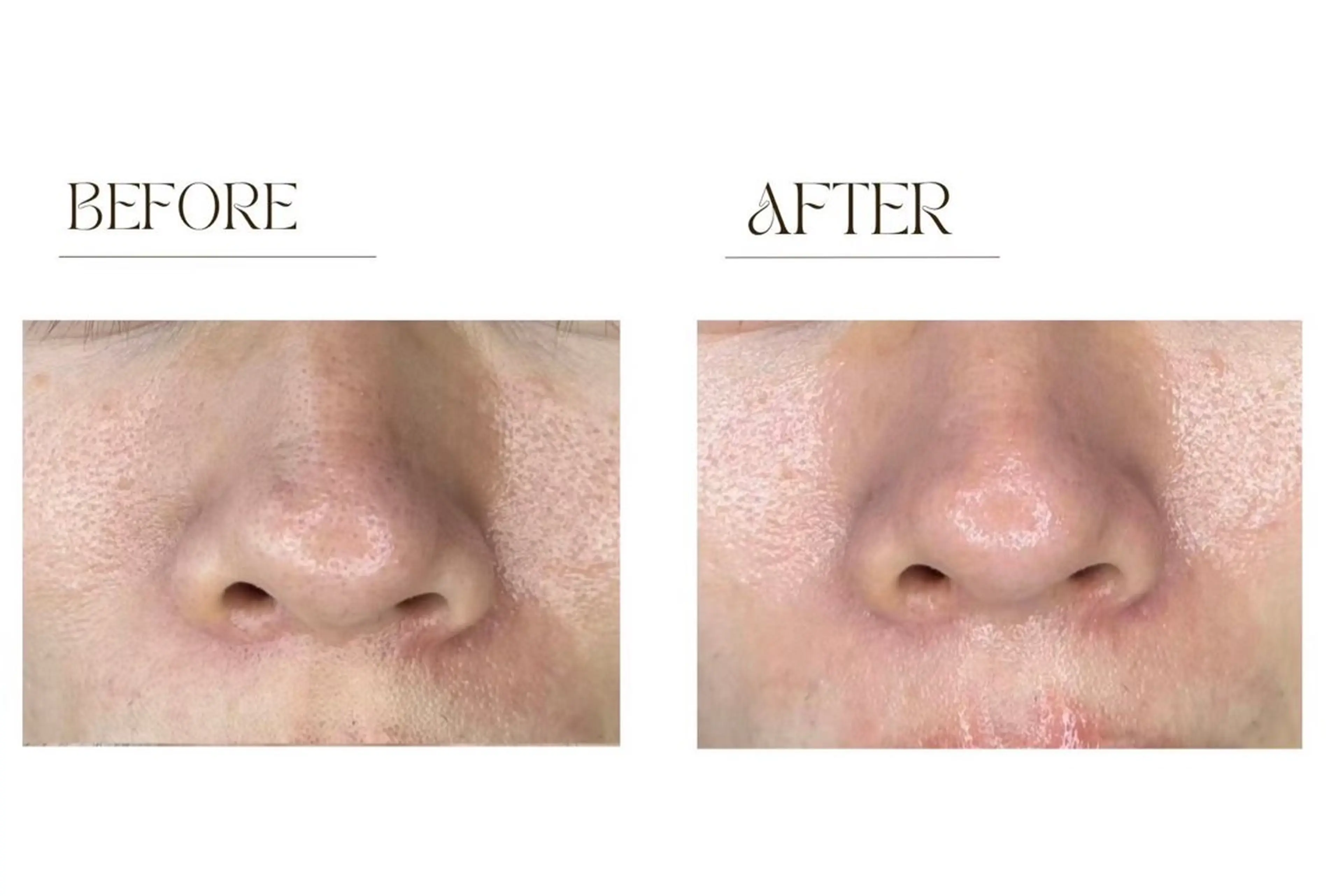 【毛穴撲滅】艶モチ◎★ララ泡洗顔+ララピール(顔首頭皮)+LALAパックの写真