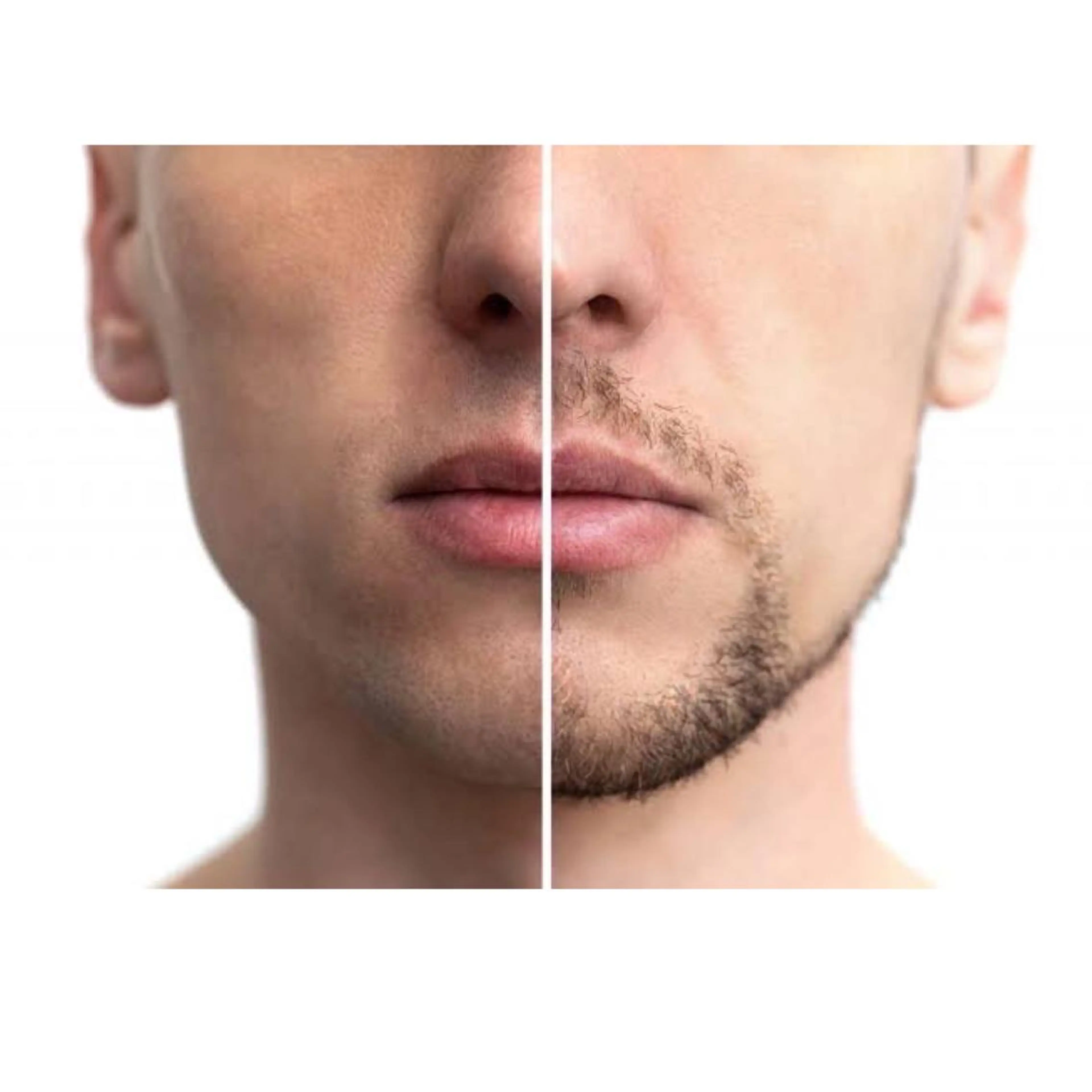 【定額払い】おヒゲ丸ごと脱毛の写真