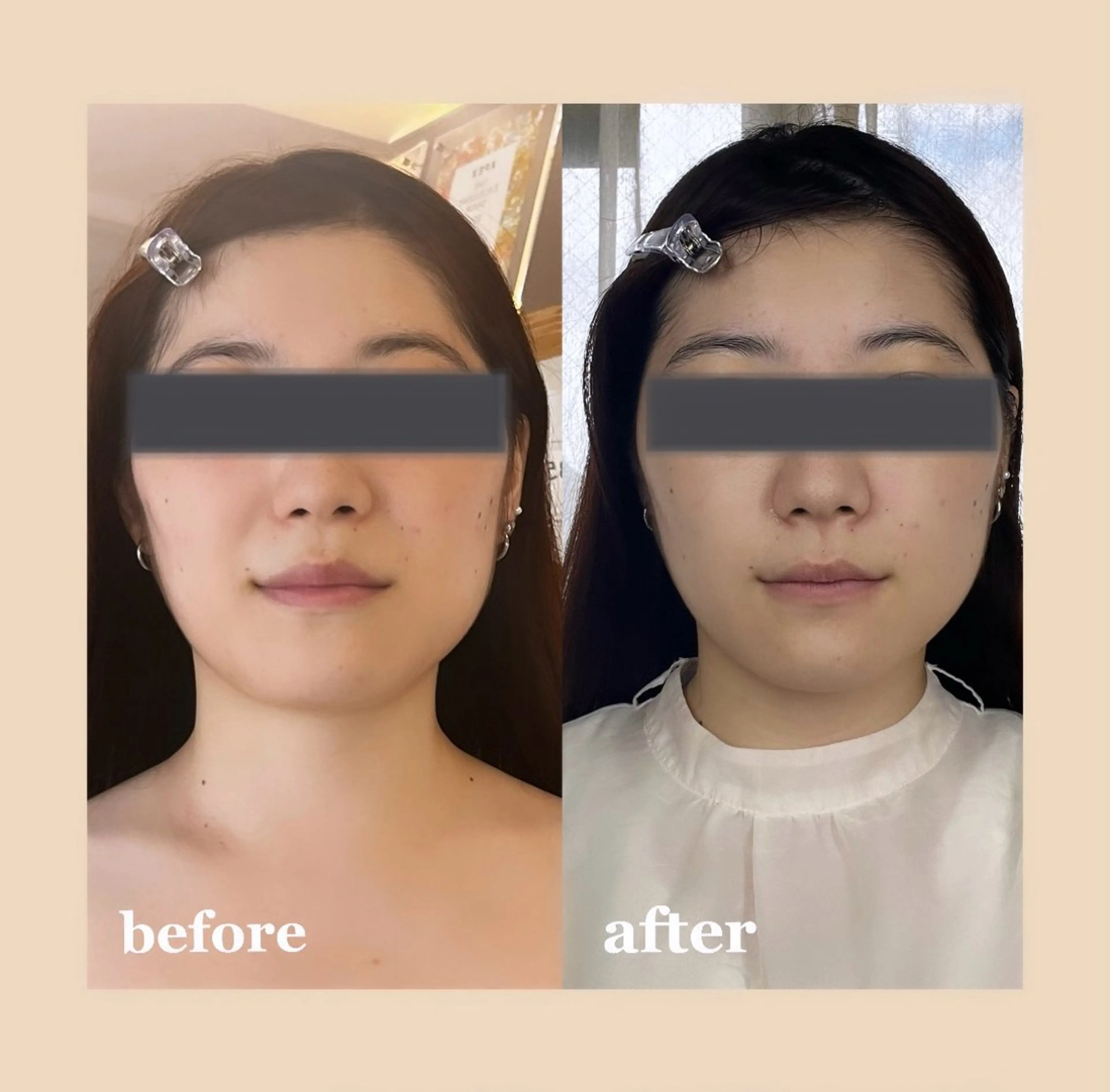 【❄️12月限定❄️】毛穴ケア・リフトアップエステ＊ホームケア1週間分プレゼント🎁の写真