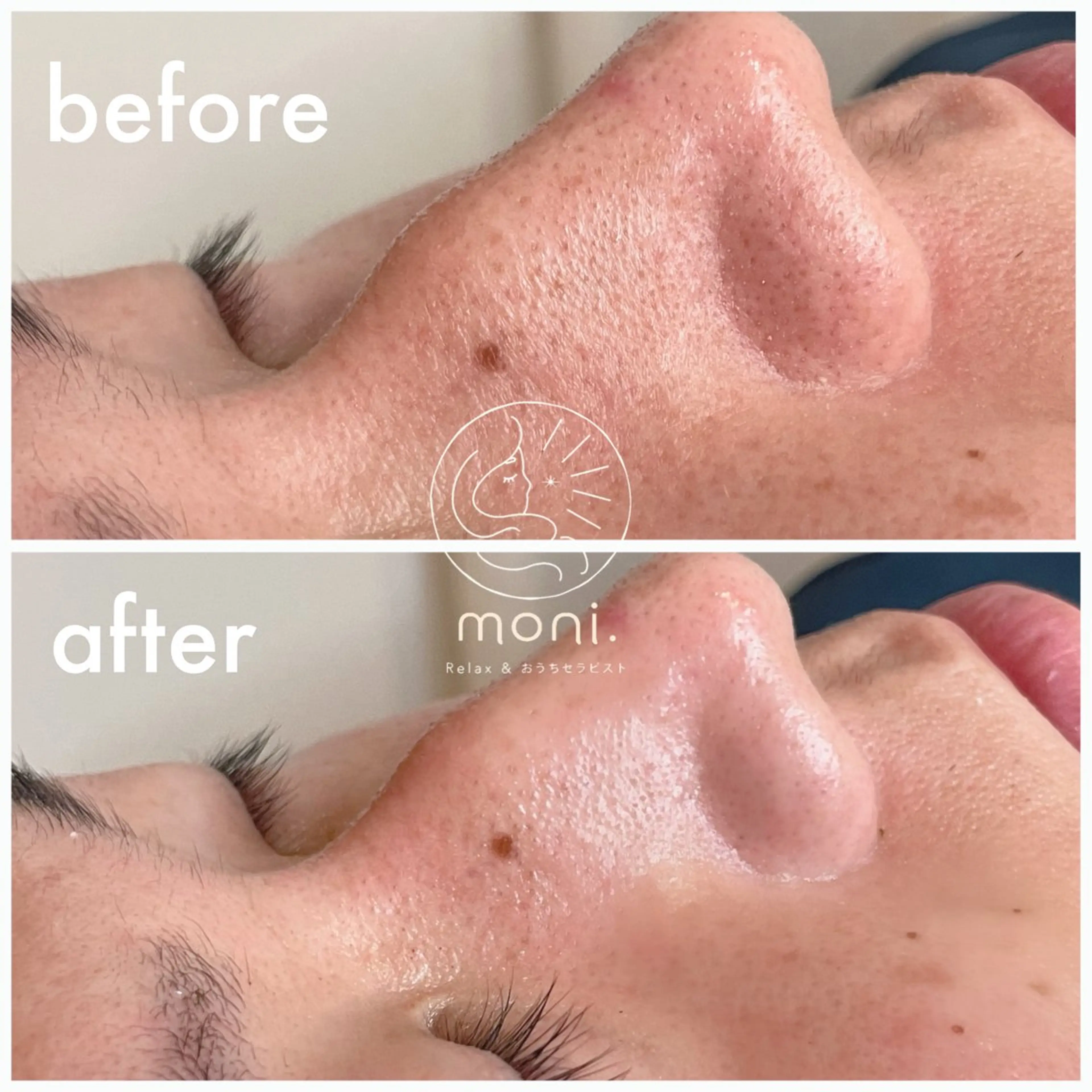 剥離無し💎.*・゚ダウンタイム無し🌿ハーブピーリング🧖♀️13,500円→4,800円の写真