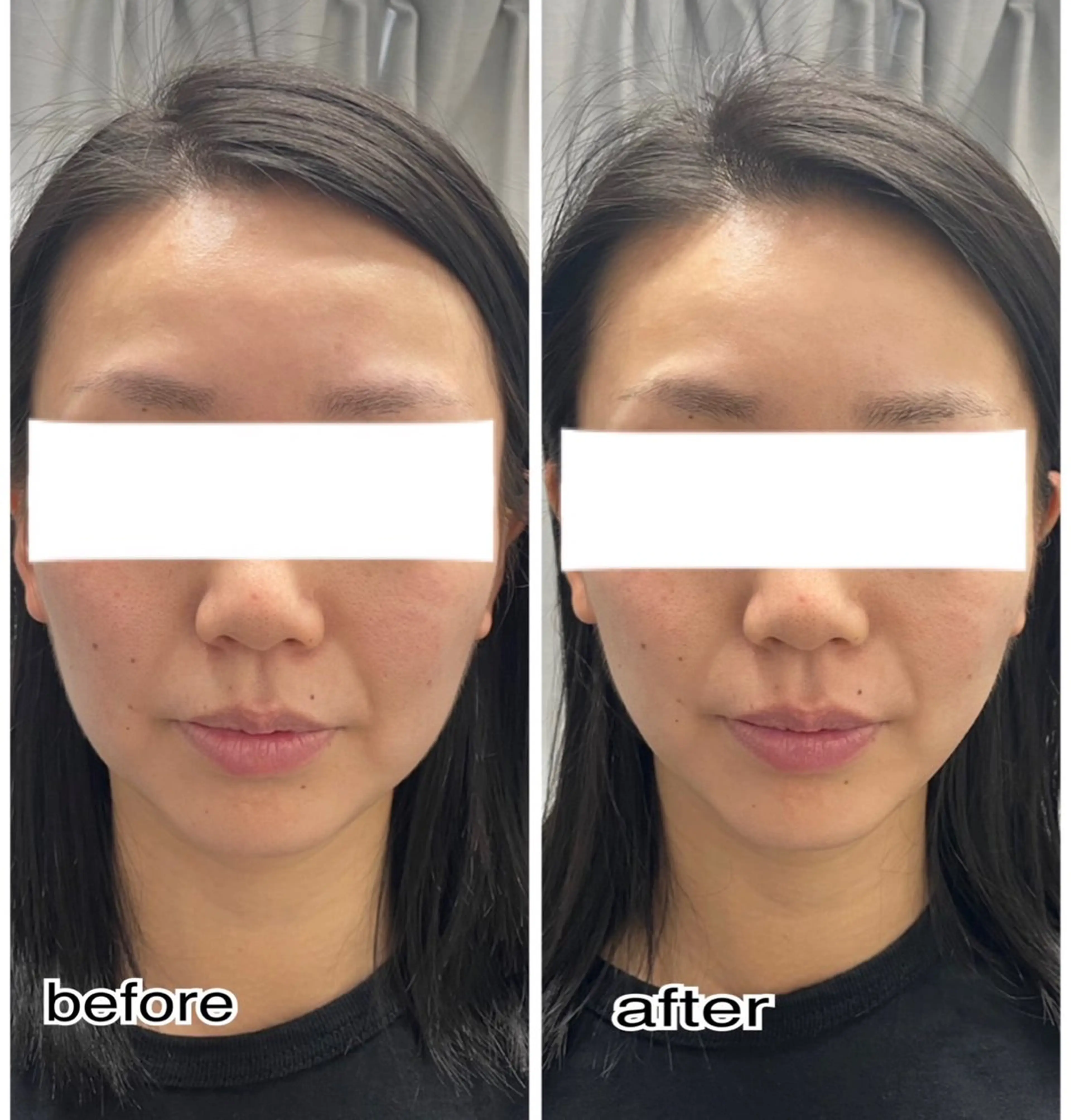 エステ ENCHANT Kaede/肌質改善のその他イメージ