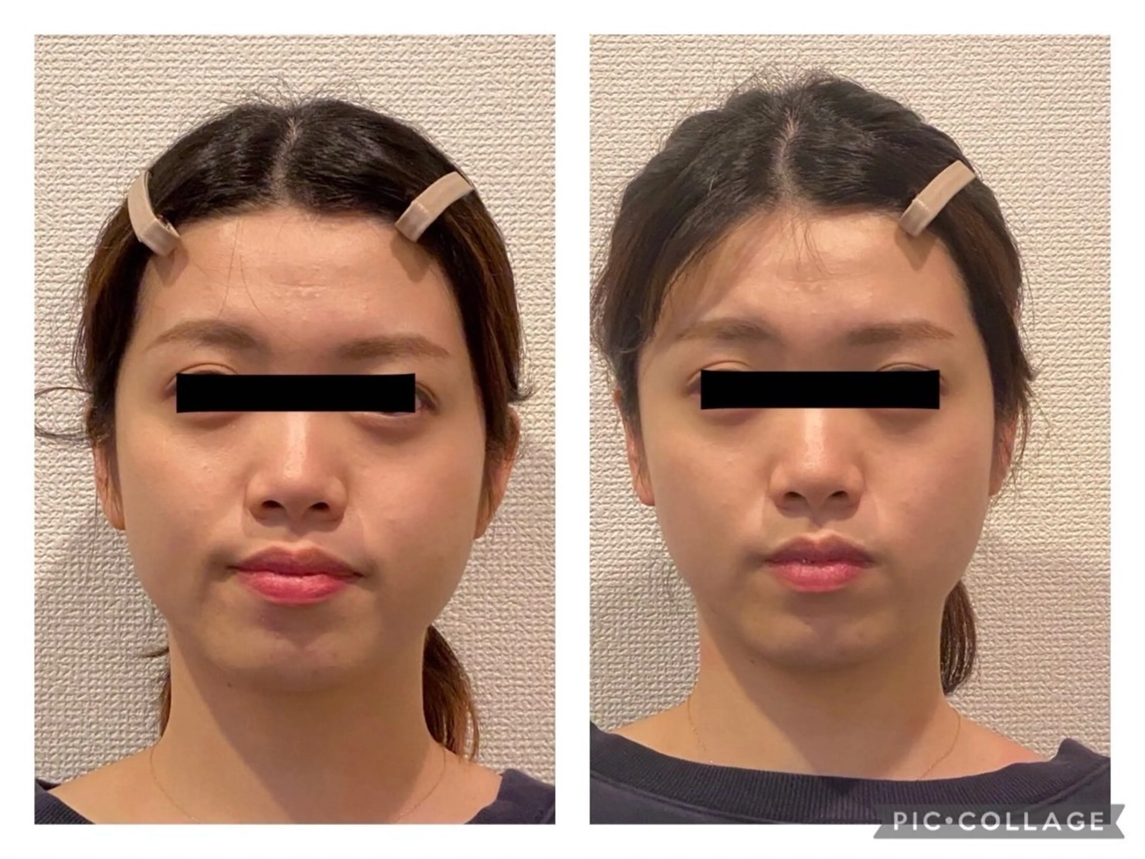 【小顔矯正コース】痛みもない施術で、小顔だけでなく頭から小さくします💡の写真