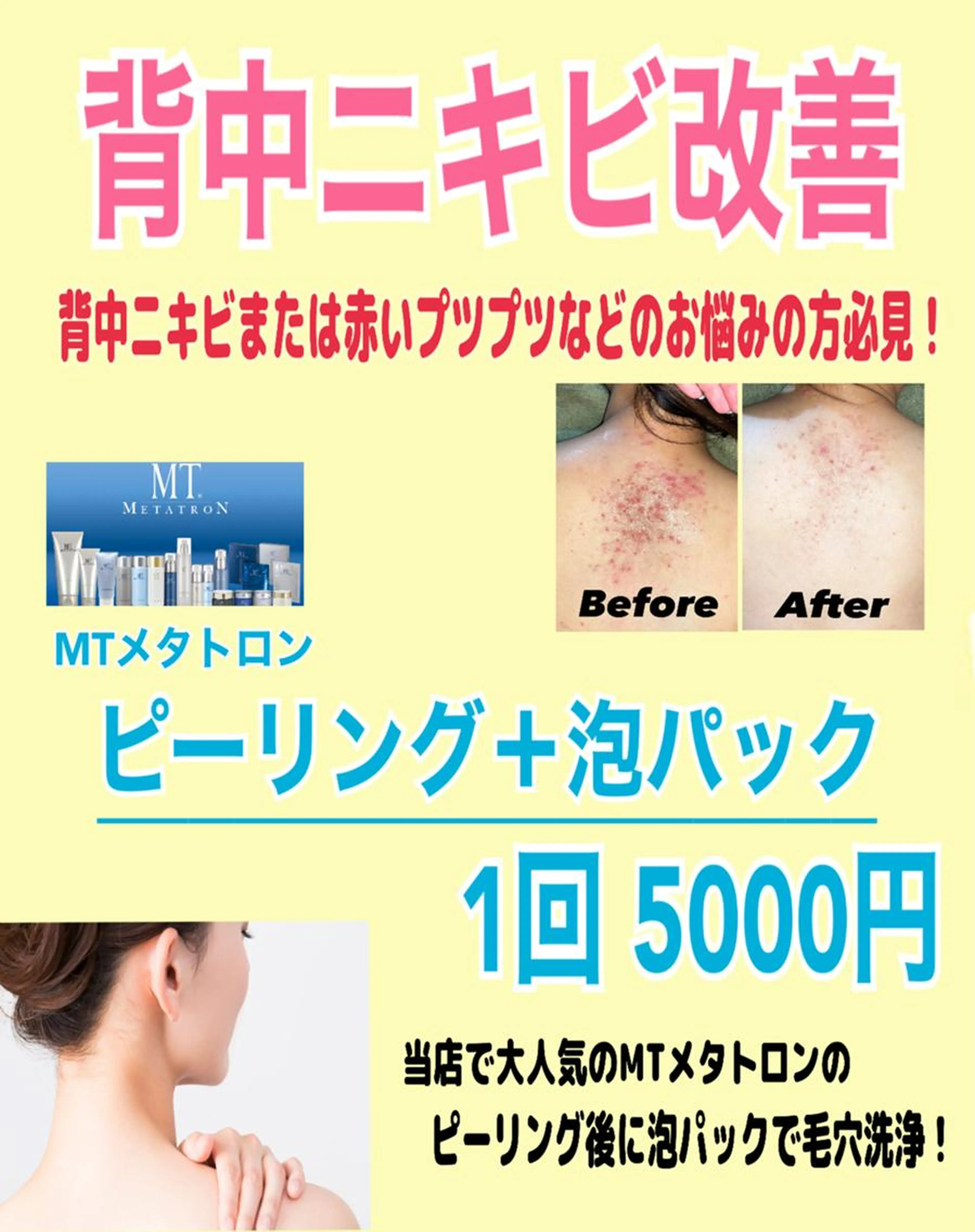 【背中ニキビ/毛穴ケア】背中ニキビケア MTピーリング＋泡パック 1回5000円の写真