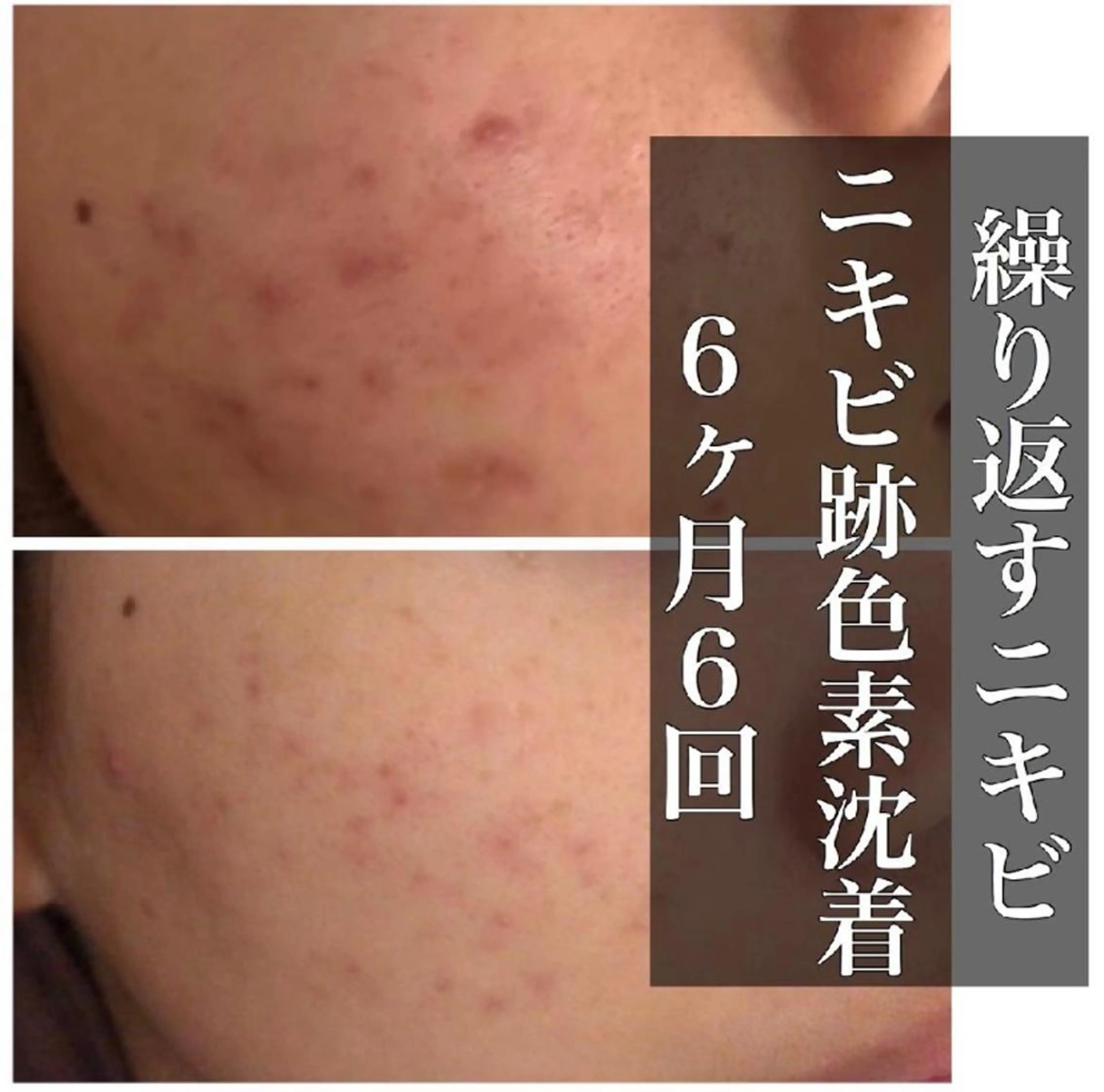 ロング カラー パーマ ヘアアレンジ メンズ キッズ ネイル マツエク・マツパ アイブロウ 夏までに肌荒れ卒業 するサロン🌻のエステ・リラクイメージ