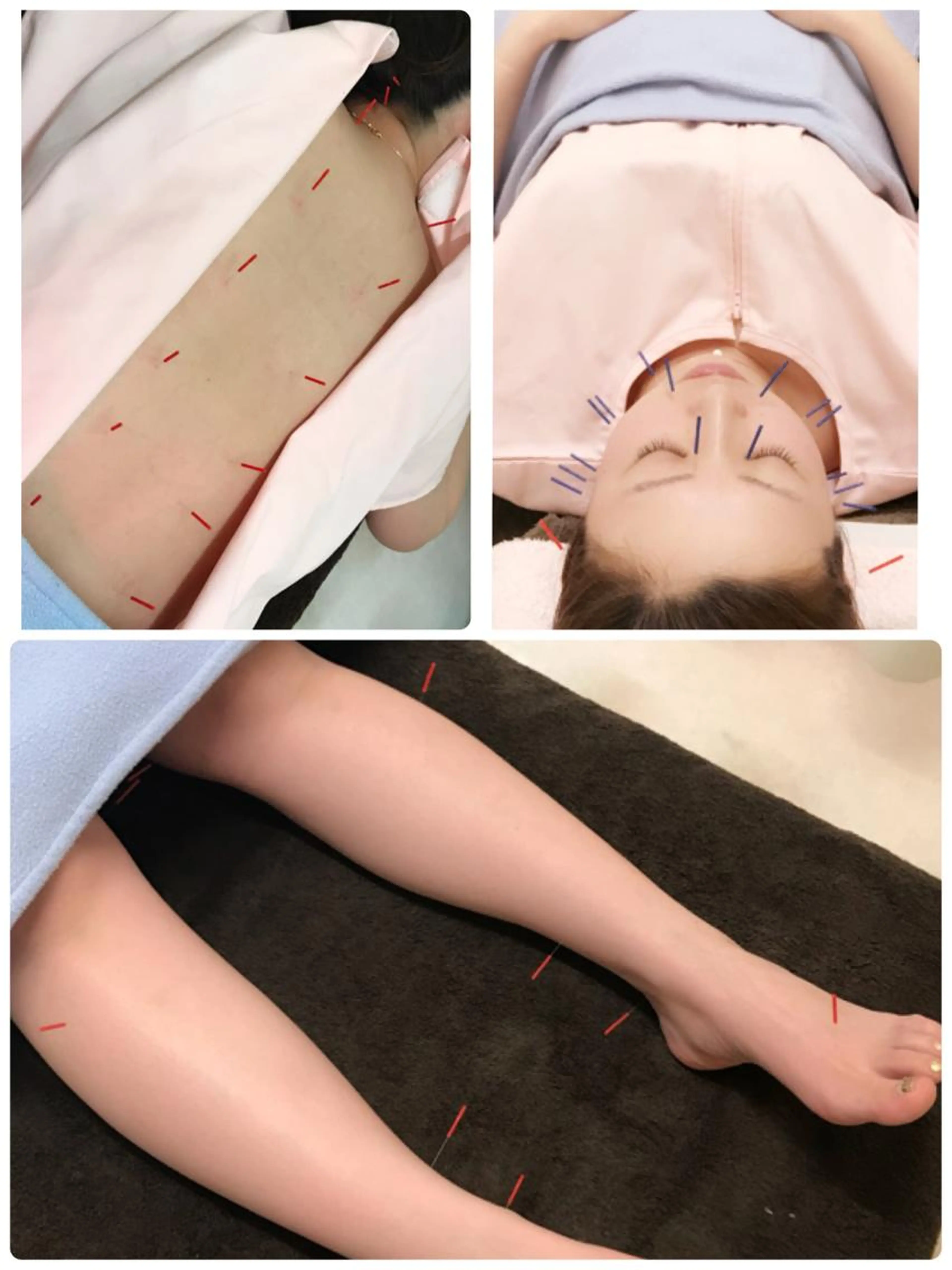 初回美容鍼スペシャルコース（全身美容鍼コース初回2000円OFF）の写真