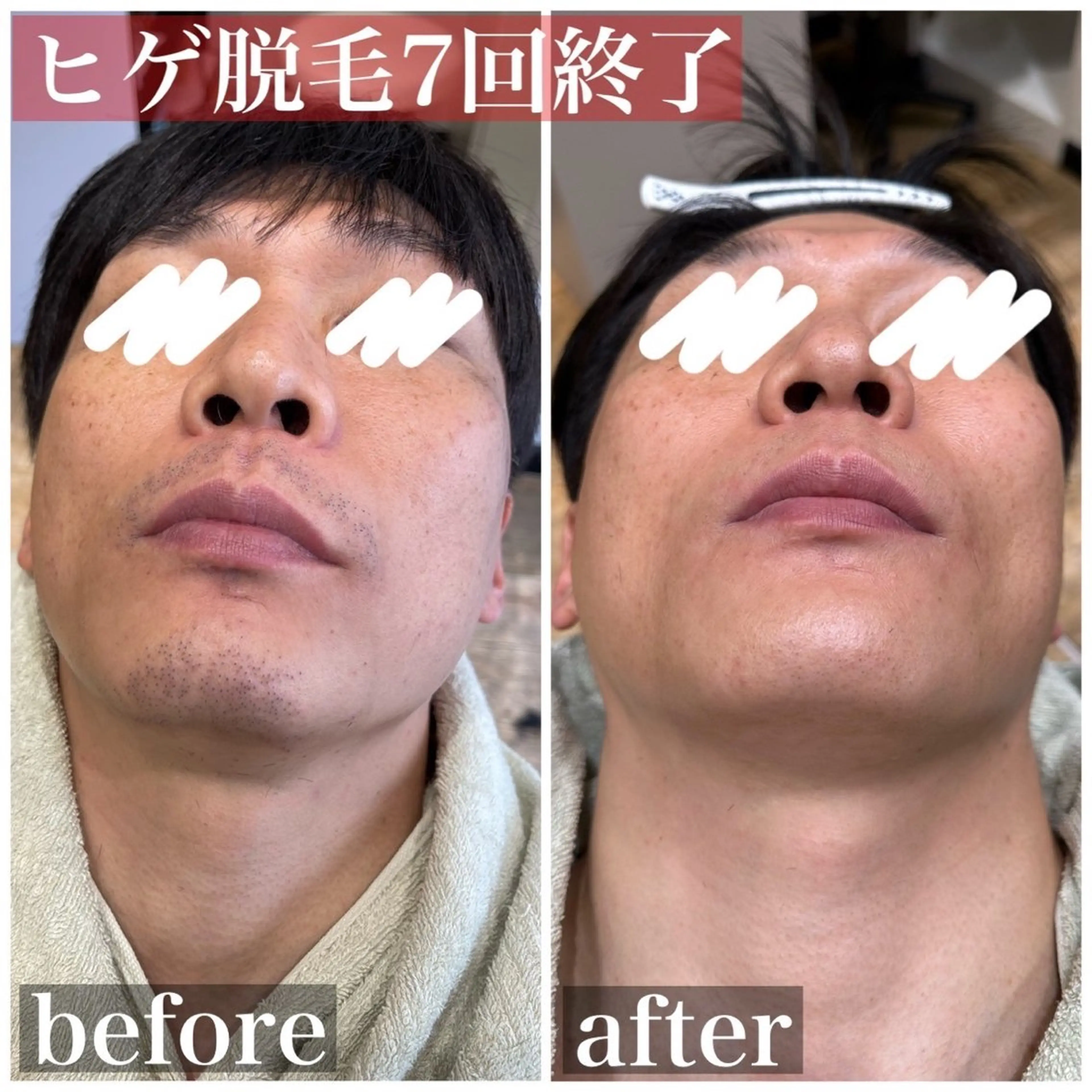 メンズ 脱毛 HAIRS YOSHIOKA所属・ヘアーズヨシオカ MENSヒゲ脱毛のエステ・リラクイメージ