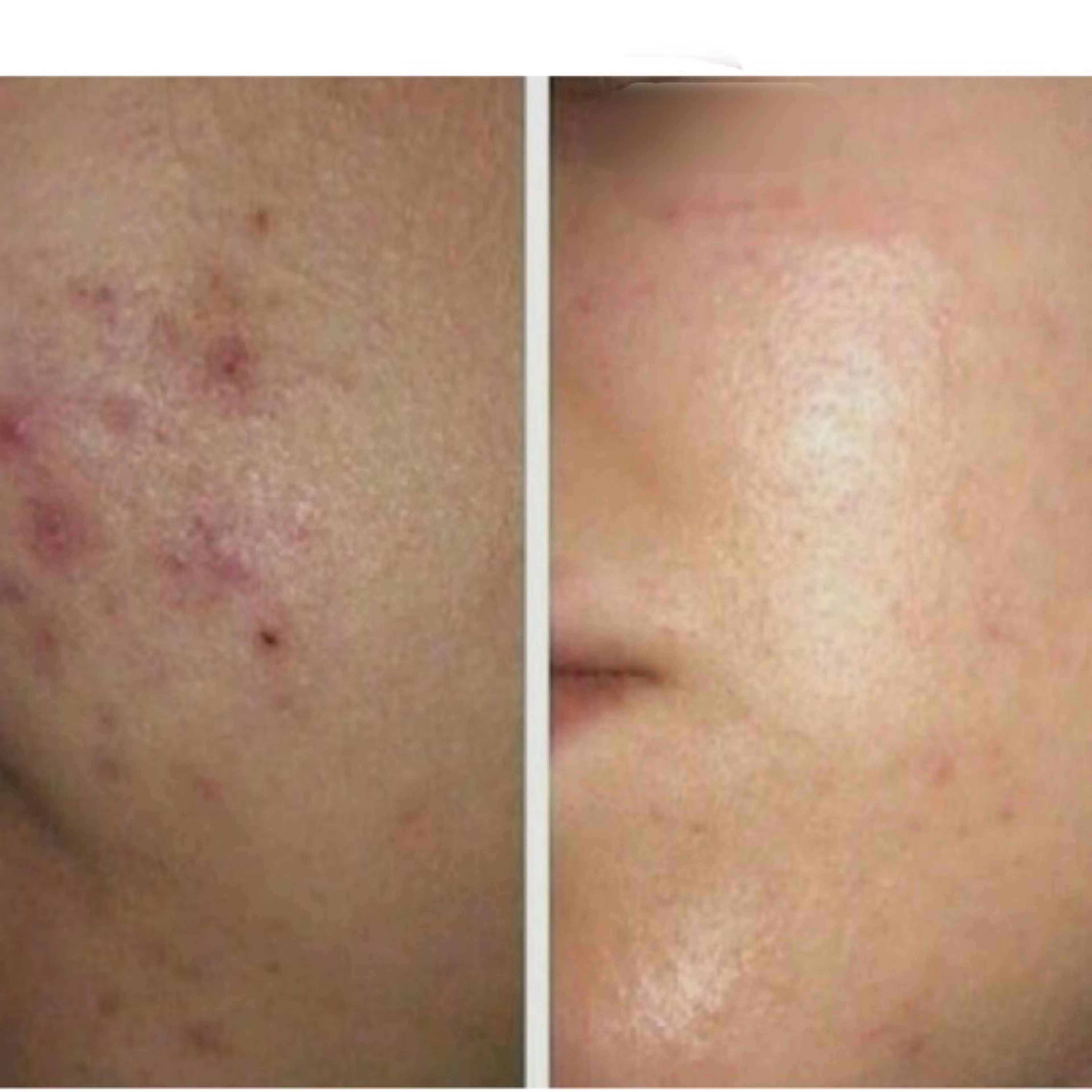 前回のお顔のハーブピーリングの施術から4週間以内の方⭐️フェイシャルハーブピーリング🌿の写真