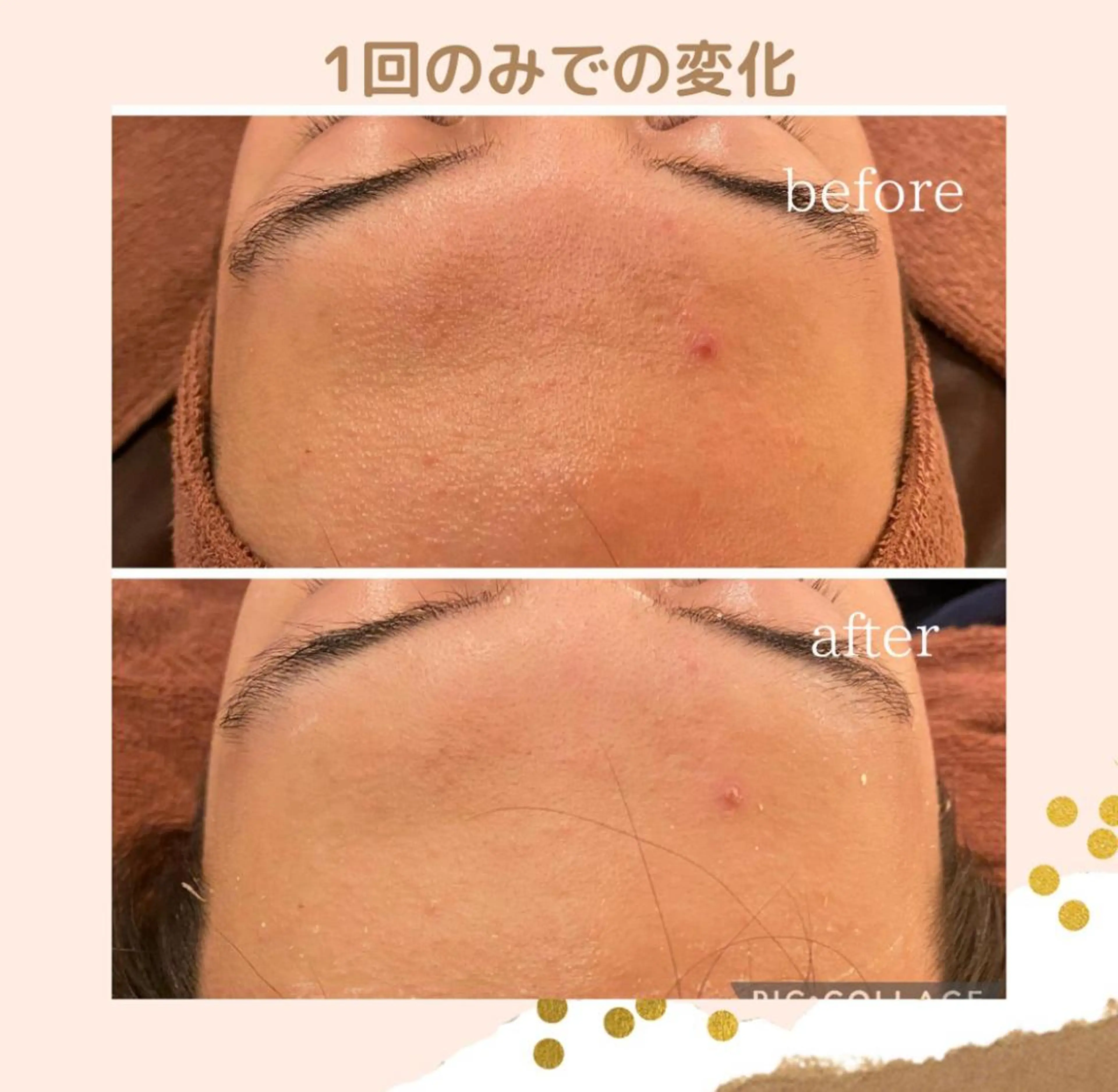 夏までに肌荒れ卒業 するサロン🌻のエステ・リラクイメージ