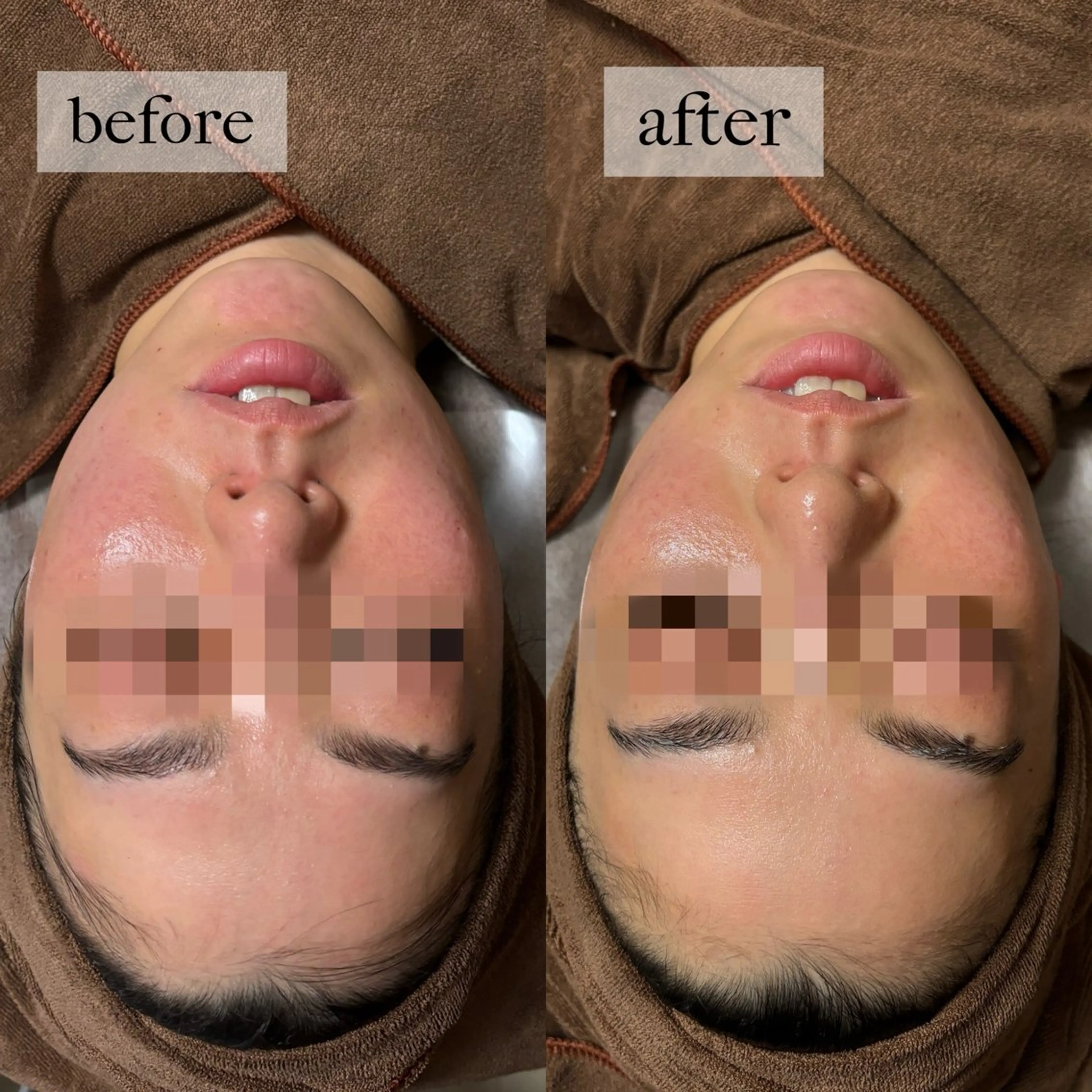 エステ HINANO矢場町店【ヒナノ】所属・脱毛/肌改善🌿 HINANO 村田のエステ・リラクイメージ