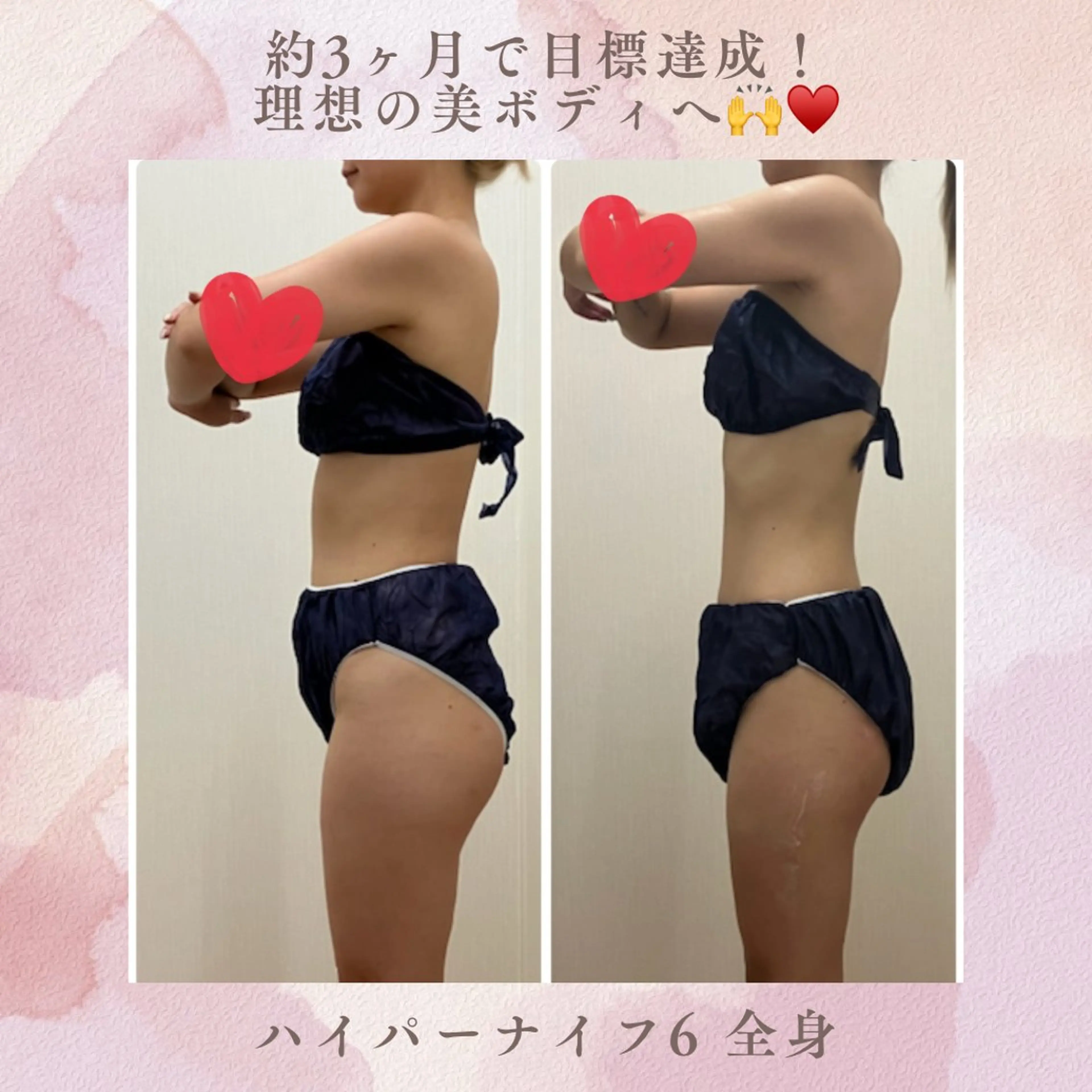 痩身エステ❤️‍🔥ハイパーナイフ全身！発汗マット&皮下脂肪4.5センチまで届く最強痩身で憧れの美ボディGET✨の写真