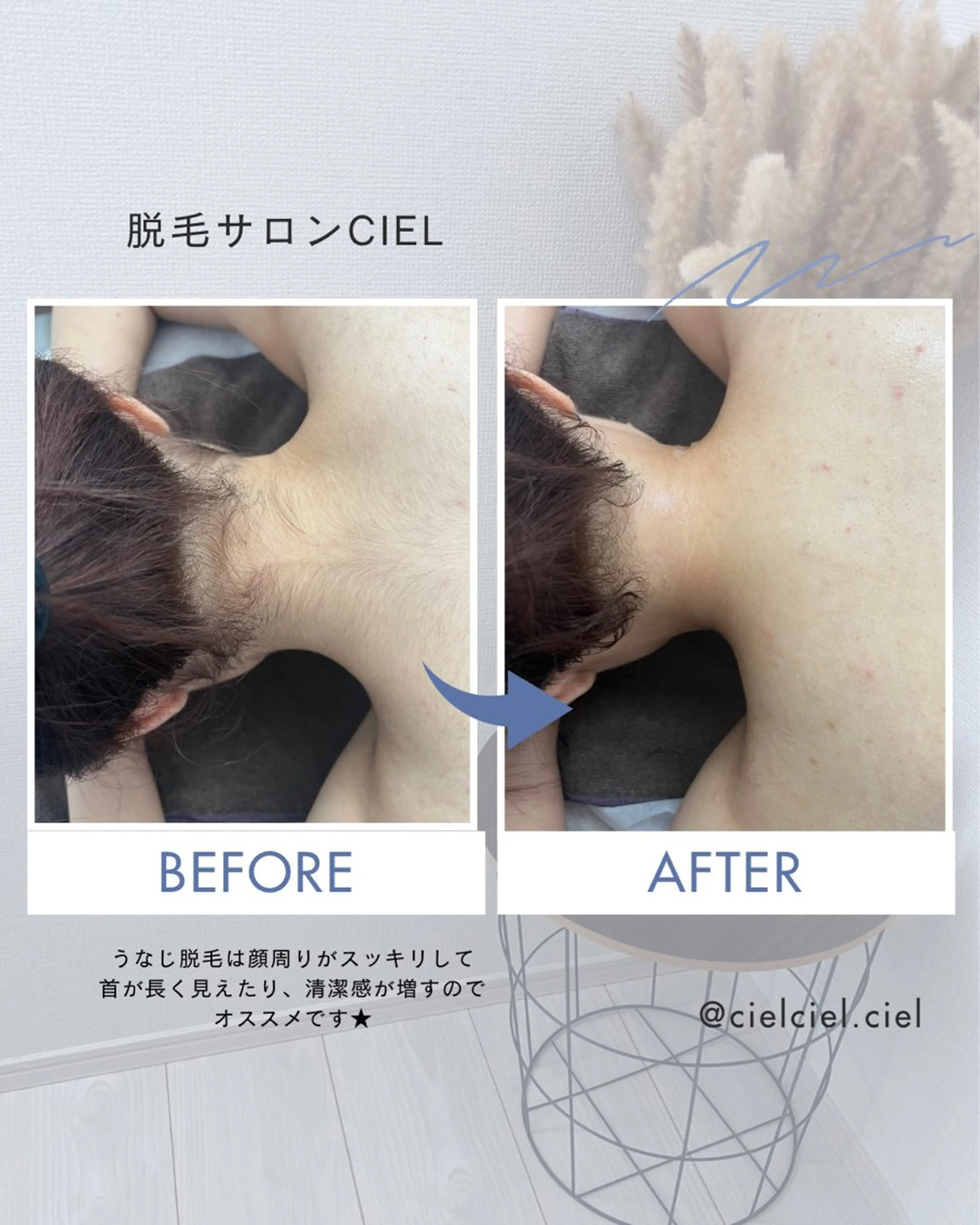 ★パーツ脱毛3ヶ所★お好きなパーツを選べます！の写真