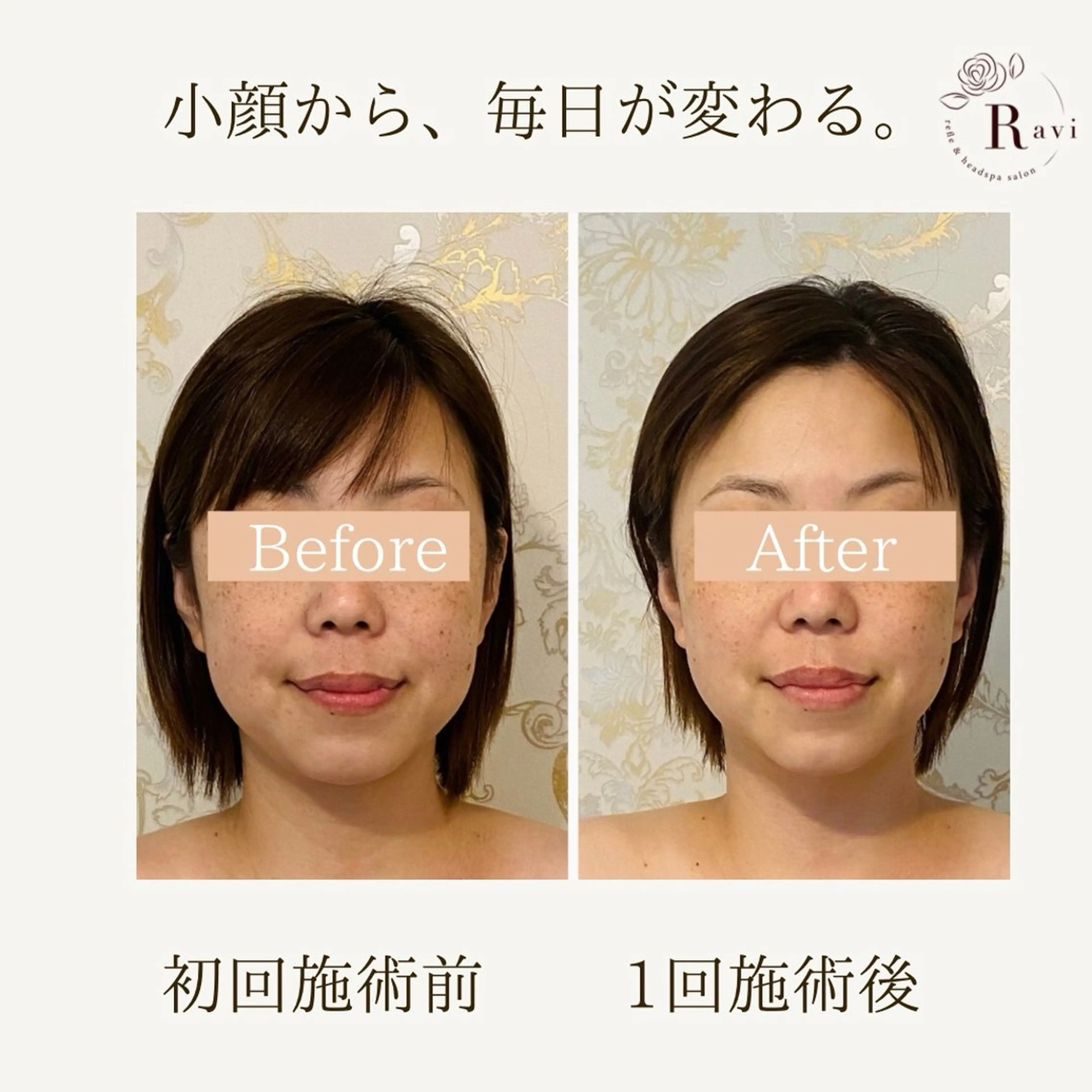 🩷ミニモ限定🩷小顔調整(シャープフェイス)+お顔リンパマッサージ<機器、デコルテマッサ、ヘッドスパ付>の写真