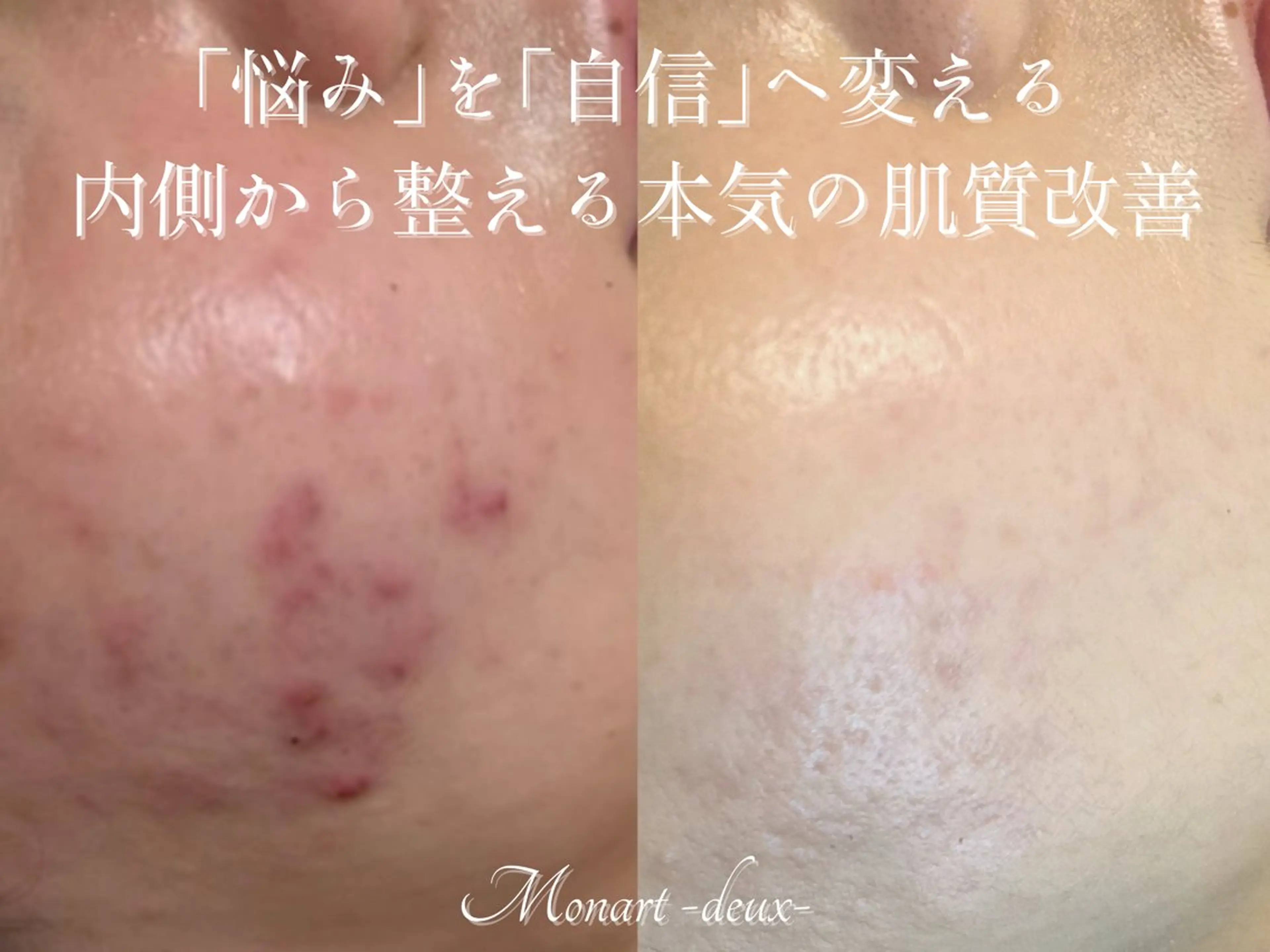 【毛穴・ニキビケア特化メニュー】肌荒れ0の白玉肌づくり♪の写真