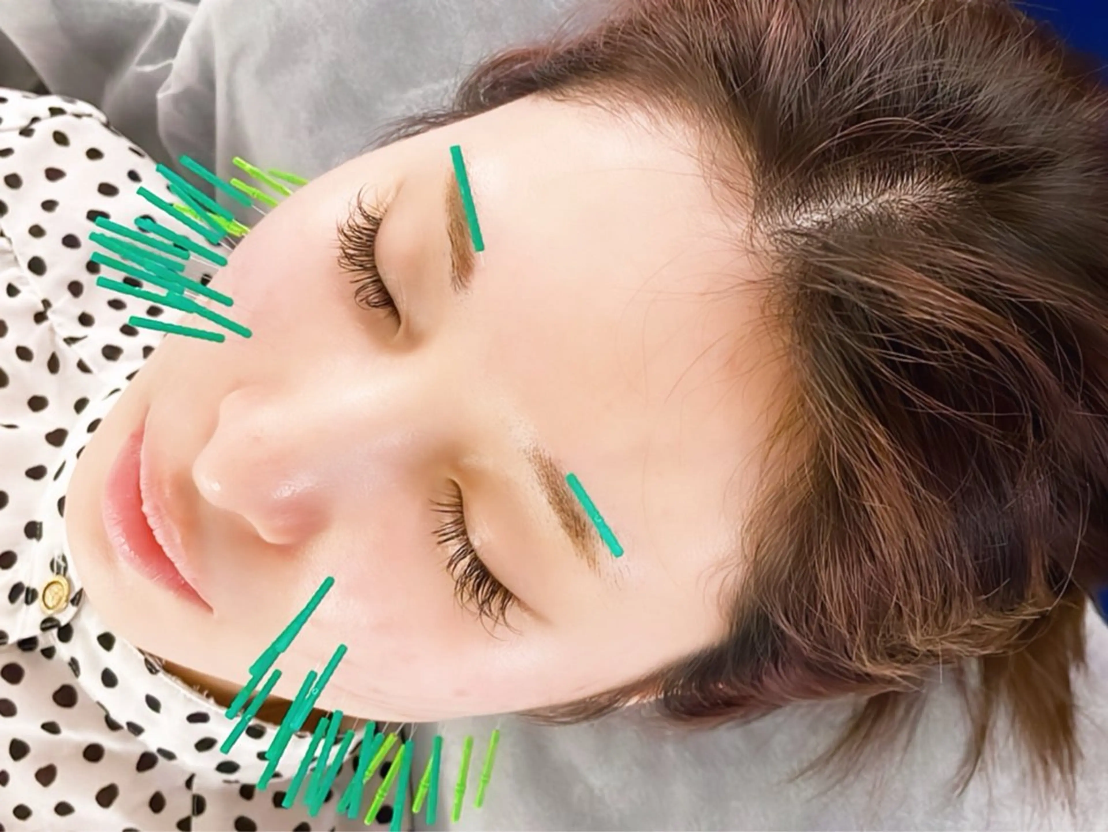 🟦美容鍼(EMSなし)🟦の写真