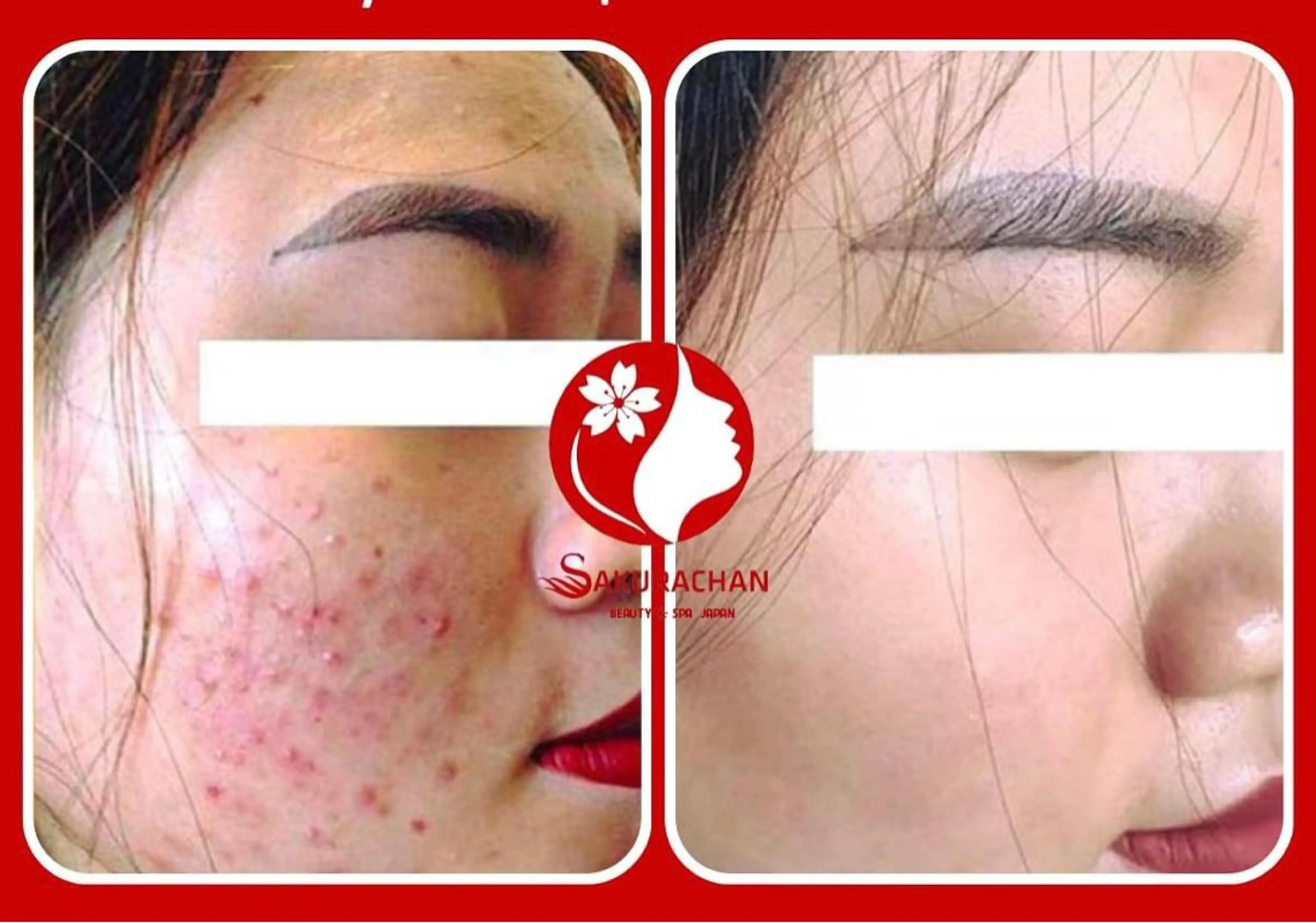 (2回体験)🈹各種ニキビ・肌あれ•ニキビ跡•敏感肌•赤ら顔•肌トラブルケア(特別毛穴洗浄とヘッドマッサージ)の写真