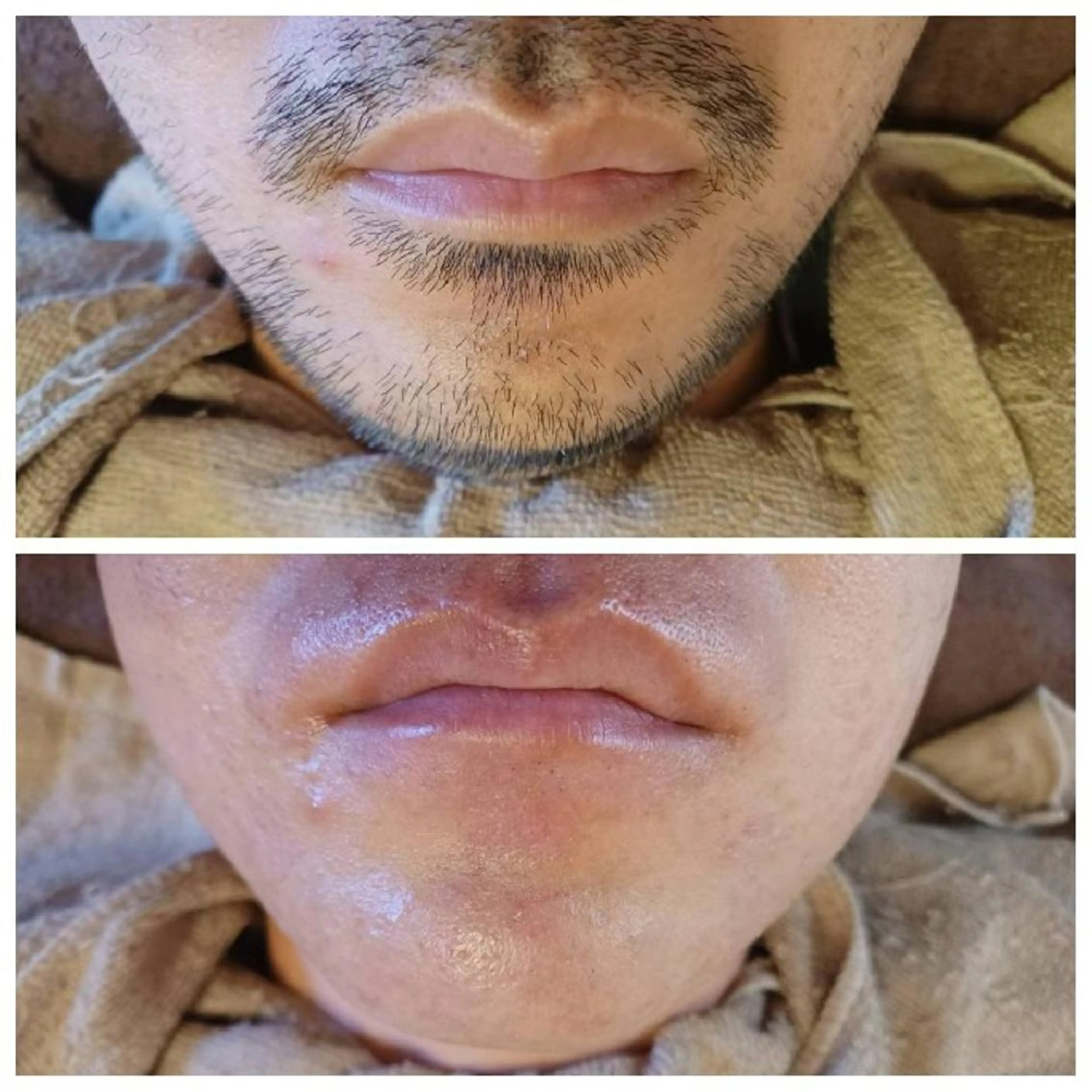 【メンズ】ヒゲ(産毛込)9,900円の写真