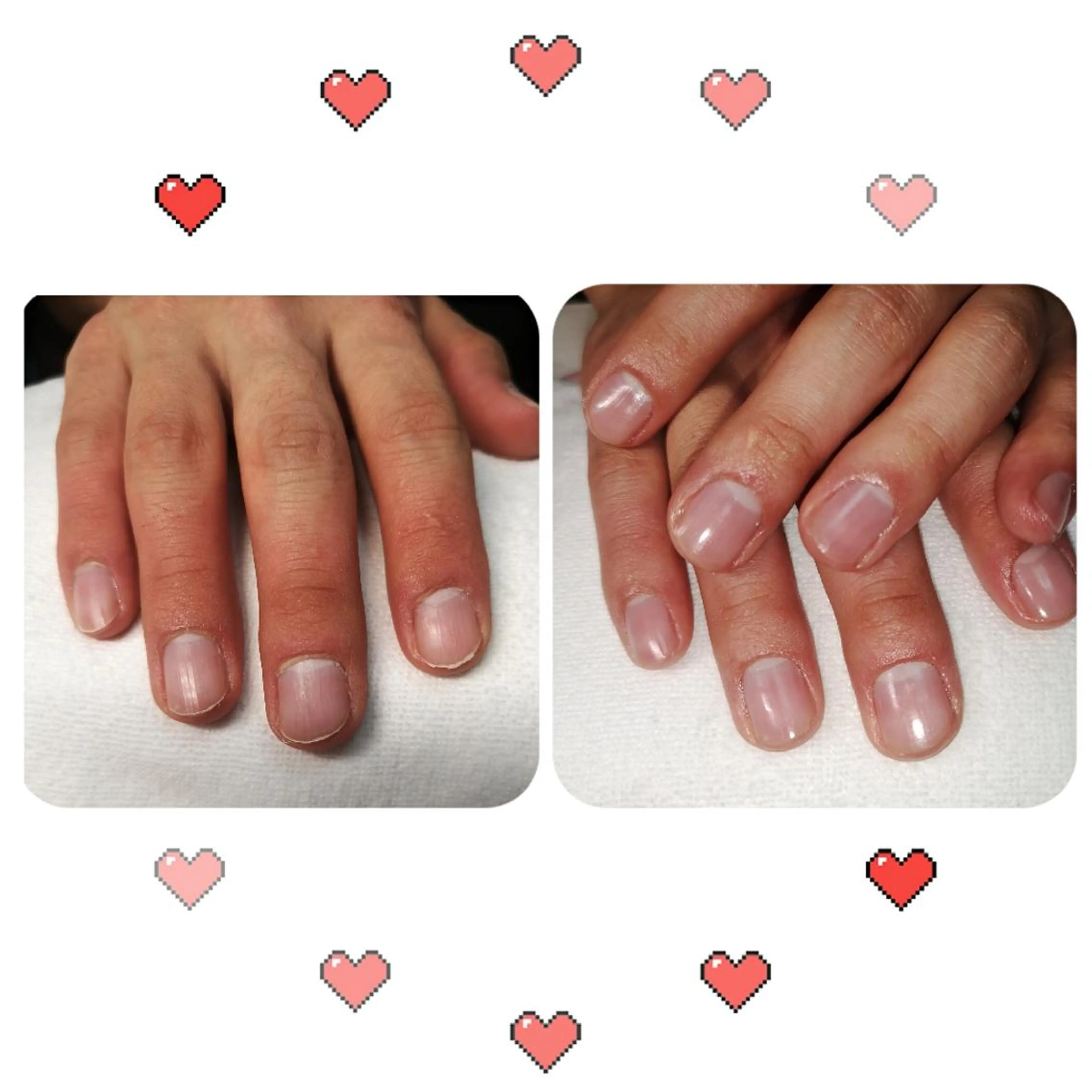 ネイル メンズネイル ネイリストゆか💅 長さだし、深爪矯正のネイルデザイン