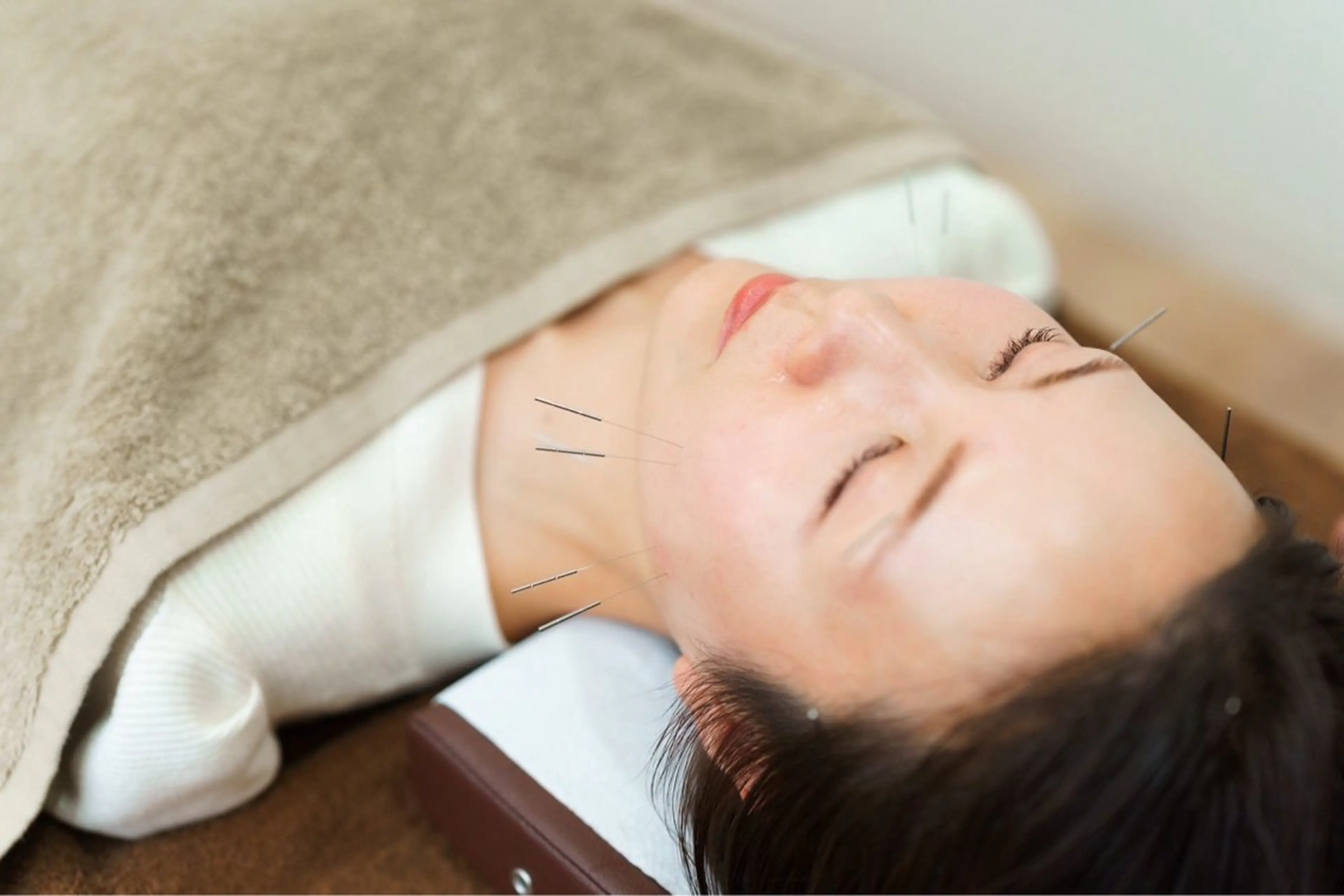 【女性限定】電気を流す美容鍼の写真