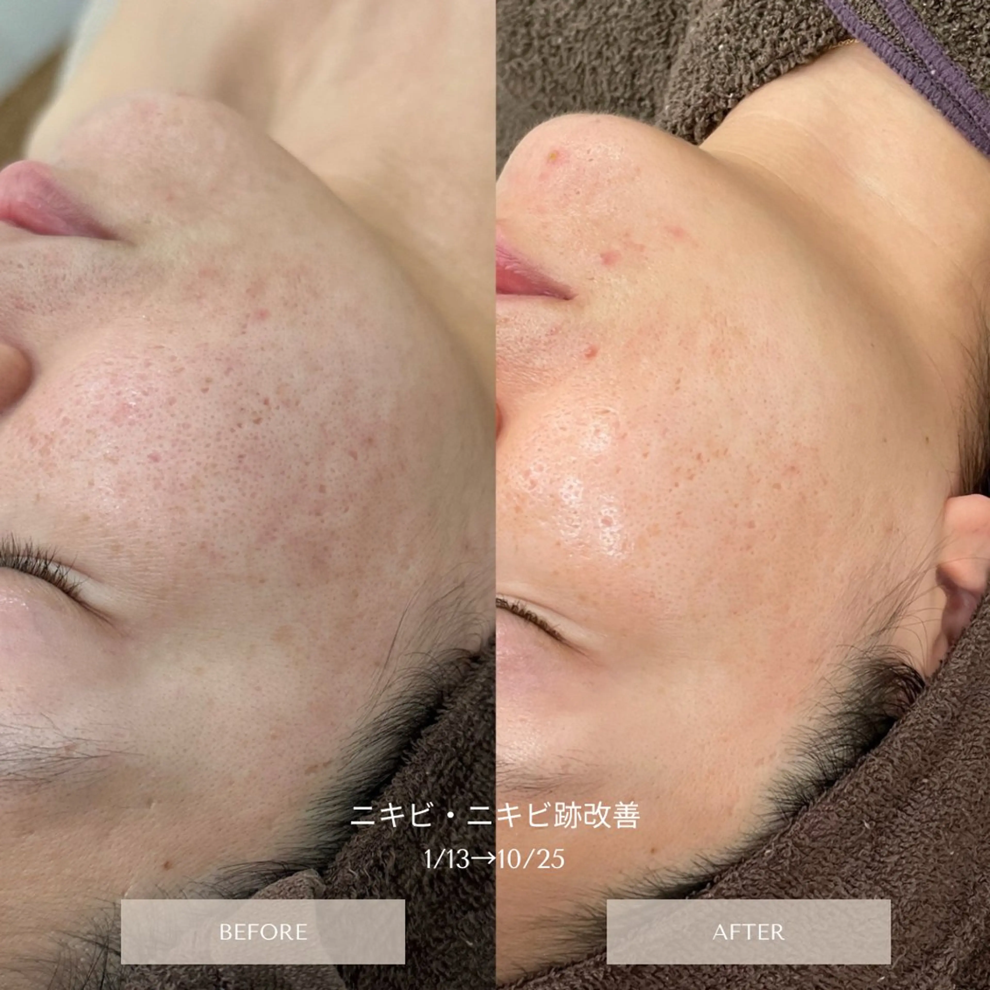 脱毛・ニキビ毛穴ケア HIMEKAのエステ・リラクイメージ